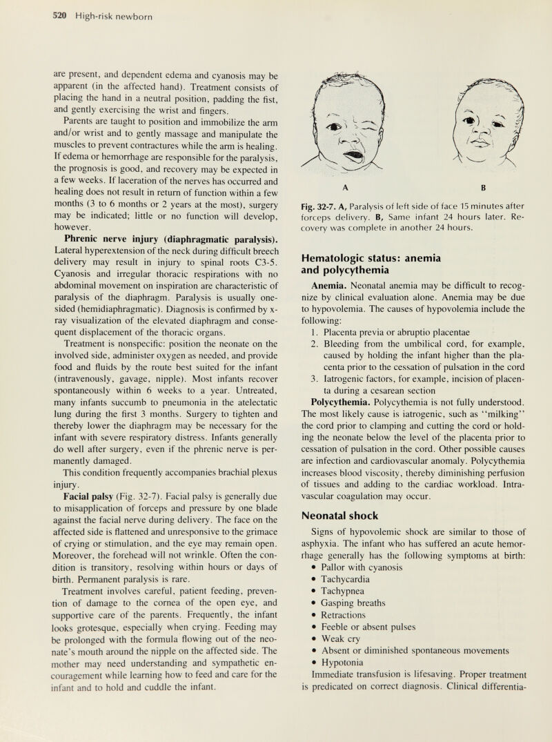 520 High-risk newborn are present, and dependent edema and cyanosis may be apparent (in the affected hand). Treatment consists of placing the hand in a neutral position, padding the fist, and gently exercising the wrist and fingers. Parents are taught to position and immobilize the arm and/or wrist and to gently massage and manipulate the muscles to prevent contractures while the arm is healing. If edema or hemorrhage are responsible for the paralysis, the prognosis is good, and recovery may be expected in a few weeks. If laceration of the nerves has occurred and healing does not result in return of function within a few months (3 to 6 months or 2 years at the most), surgery may be indicated; little or no function will develop, however. Phrenic nerve injury (diaphragmatic paralysis). Lateral hyperextension of the neck during difficult breech delivery may result in injury to spinal roots C3-5. Cyanosis and irregular thoracic respirations with no abdominal movement on inspiration are characteristic of paralysis of the diaphragm. Paralysis is usually one¬ sided (hemidiaphragmatic). Diagnosis is confirmed by x- ray visualization of the elevated diaphragm and conse¬ quent displacement of the thoracic organs. Treatment is nonspecific: position the neonate on the involved side, administer oxygen as needed, and provide food and ñuids by the route best suited for the infant (intravenously, gavage, nipple). Most infants recover spontaneously within 6 weeks to a year. Untreated, many infants succumb to pneumonia in the atelectatic lung during the first 3 months. Surgery to tighten and thereby lower the diaphragm may be necessary for the infant with severe respiratory distress. Infants generally do well after surgery, even if the phrenic nerve is per¬ manently damaged. This condition frequently accompanies brachial plexus injury. Facial palsy (Fig. 32-7). Facial palsy is generally due to misapplication of forceps and pressure by one blade against the facial nerve during delivery. The face on the affected side is flattened and unresponsive to the grimace of crying or stimulation, and the eye may remain open. Moreover, the forehead will not wrinkle. Often the con¬ dition is transitory, resolving within hours or days of birth. Permanent paralysis is rare. Treatment involves careful, patient feeding, preven¬ tion of damage to the cornea of the open eye, and supportive care of the parents. Frequently, the infant looks grotesque, especially when crying. Feeding may be prolonged with the formula flowing out of the neo¬ nate's mouth around the nipple on the affected side. The mother may need understanding and sympathetic en¬ couragement while learning how to feed and care for the infant and to hold and cuddle the infant. f A В Fig. 32-7. A, Paralysis of left side of face 15 minutes after forceps delivery. B, Same infant 24 hours later. Re¬ covery was complete in another 24 hours. Hematologic status: anemia and polycythemia Anemia. Neonatal anemia may be difficult to recog¬ nize by clinical evaluation alone. Anemia may be due to hypovolemia. The causes of hypovolemia include the following: 1. Placenta previa or abruptio placentae 2. Bleeding from the umbilical cord, for example, caused by holding the infant higher than the pla¬ centa prior to the cessation of pulsation in the cord 3. Iatrogenic factors, for example, incision of placen¬ ta during a cesarean section Polycythemia. Polycythemia is not fully understood. The most likely cause is iatrogenic, such as milking the cord prior to clamping and cutting the cord or hold¬ ing the neonate below the level of the placenta prior to cessation of pulsation in the cord. Other possible causes are infection and cardiovascular anomaly. Polycythemia increases blood viscosity, thereby diminishing perfusion of tissues and adding to the cardiac workload. Intra¬ vascular coagulation may occur. Neonatal shock Signs of hypovolemic shock are similar to those of asphyxia. The infant who has suffered an acute hemor¬ rhage generally has the following symptoms at birth; • Pallor with cyanosis • Tachycardia • Tachypnea • Gasping breaths • Retractions • Feeble or absent pulses • Weak cry • Absent or diminished spontaneous movements • Hypotonia Immediate transfusion is lifesaving. Proper treatment is predicated on correct diagnosis. Clinical differentia-