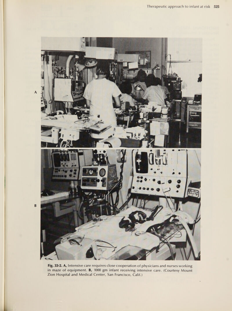 Therapeutic approach to infant at risk Fig. 33-2. A, Intensive care requires close cooperation of physicians and nurses working in maze of equipment. B, 1000 gm infant receiving intensive care. (Courtesy Mount Zion Hospital and Medical Center, San Francisco, Calif.)