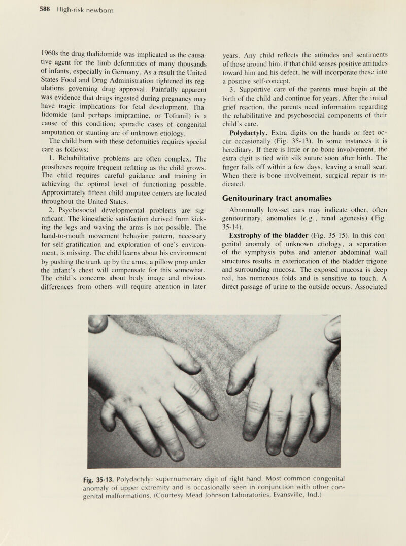 588 High-risk newborn 1960s the drug thalidomide was implicated as the causa¬ tive agent for the limb deformities of many thousands of infants, especially in Germany. As a result the United States Food and Drug Administration tightened its reg¬ ulations governing drug approval. Painfully apparent was evidence that drugs ingested during pregnancy may have tragic implications for fetal development. Tha¬ lidomide (and perhaps imipramine, or Tofranil) is a cause of this condition; sporadic cases of congenital amputation or stunting are of unknown etiology. The child born with these deformities requires special care as follows: 1. Rehabilitative problems are often complex. The prostheses require frequent refitting as the child grows. The child requires careful guidance and training in achieving the optimal level of functioning possible. Approximately fifteen child amputee centers are located throughout the United States. 2. Psychosocial developmental problems are sig¬ nificant. The kinesthetic satisfaction derived from kick¬ ing the legs and waving the arms is not possible. The hand-to-mouth movement behavior pattern, necessary for self-gratification and exploration of one's environ¬ ment, is missing. The child learns about his environment by pushing the trunk up by the arms; a pillow prop under the infant's chest will compensate for this somewhat. The child's concerns about body image and obvious differences from others will require attention in later years. Any child reflects the attitudes and sentiments of those around him; if that child senses positive attitudes toward him and his defect, he will incoфorate these into a positive self-concept. 3. Supportive care of the parents must begin at the birth of the child and continue for years. After the initial grief reaction, the parents need information regarding the rehabilitative and psychosocial components of their child's care. Polydactyly. Extra digits on the hands or feet oc¬ cur occasionally (Fig. 35-13). In some instances it is hereditary. If there is little or no bone involvement, the extra digit is tied with silk suture soon after birth. The finger falls off within a few days, leaving a small scar. When there is bone involvement, surgical repair is in¬ dicated. Genitourinary tract anomalies Abnormally low-set ears may indicate other, often genitourinary, anomalies (e.g., renal agenesis) (Fig. 35-14). Exstrophy of the bladder (Fig. 35-15). In this con¬ genital anomaly of unknown etiology, a separation of the symphysis pubis and anterior abdominal wall structures results in exterioration of the bladder trigone and surrounding mucosa. The exposed mucosa is deep red, has numerous folds and is sensitive to touch. A direct passage of urine to the outside occurs. Associated Fig. 35-13. Polydactyly: supernumerary digit of right hand. Most common congenital anomaly of upper extremity and is occasionally seen in conjunction with other con¬ genital malformations. (Courtesy Mead Johnson Laboratories, Evansville, Ind.)
