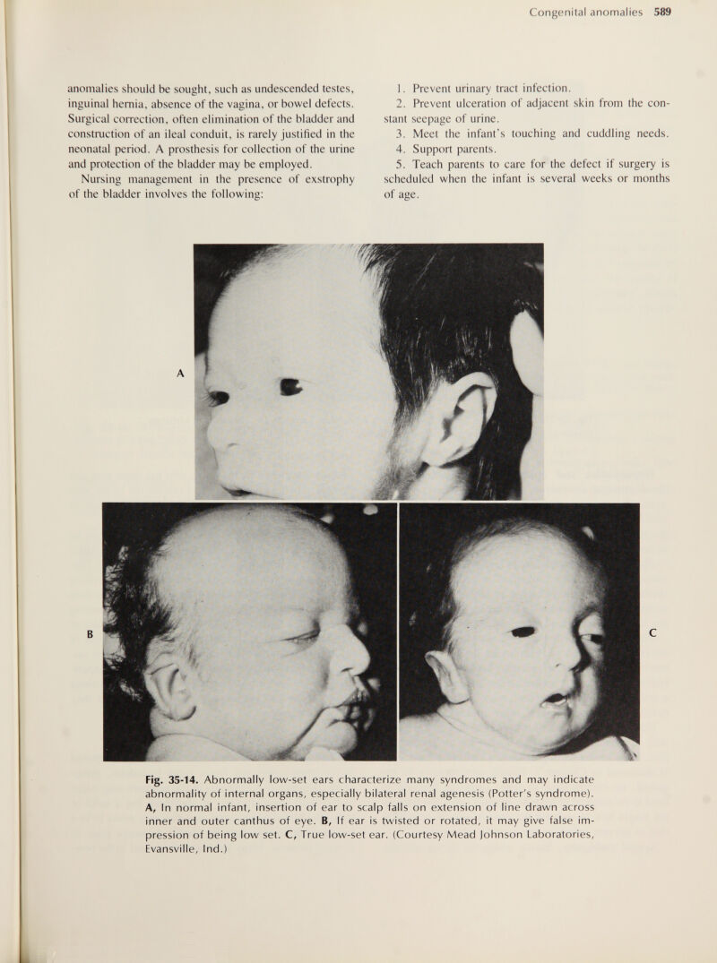 Congenital anomalies 589 anomalies should be sought, such as undescended testes, inguinal hernia, absence of the vagina, or bowel defects. Surgical correction, often elimination of the bladder and construction of an ileal conduit, is rarely justified in the neonatal period. A prosthesis for collection of the urine and protection of the bladder may be employed. Nursing management in the presence of exstrophy of the bladder involves the following: 1. Prevent urinary tract infection. 2. Prevent ulceration of adjacent skin from the con¬ stant seepage of urine. 3. Meet the infant's touching and cuddling needs. 4. Support parents. 5. Teach parents to care for the defect if surgery is scheduled when the infant is several weeks or months of age. i Flg. 35-14. Abnormally low-set ears characterize many syndromes and may indicate abnormality of internal organs, especially bilateral renal agenesis (Potter's syndrome). A, In normal infant, insertion of ear to scalp falls on extension of line drawn across inner and outer canthus of eye. B, If ear is twisted or rotated, it may give false im¬ pression of being low set. C, True low-set ear. (Courtesy Mead Johnson Laboratories, Evansville, Ind.)