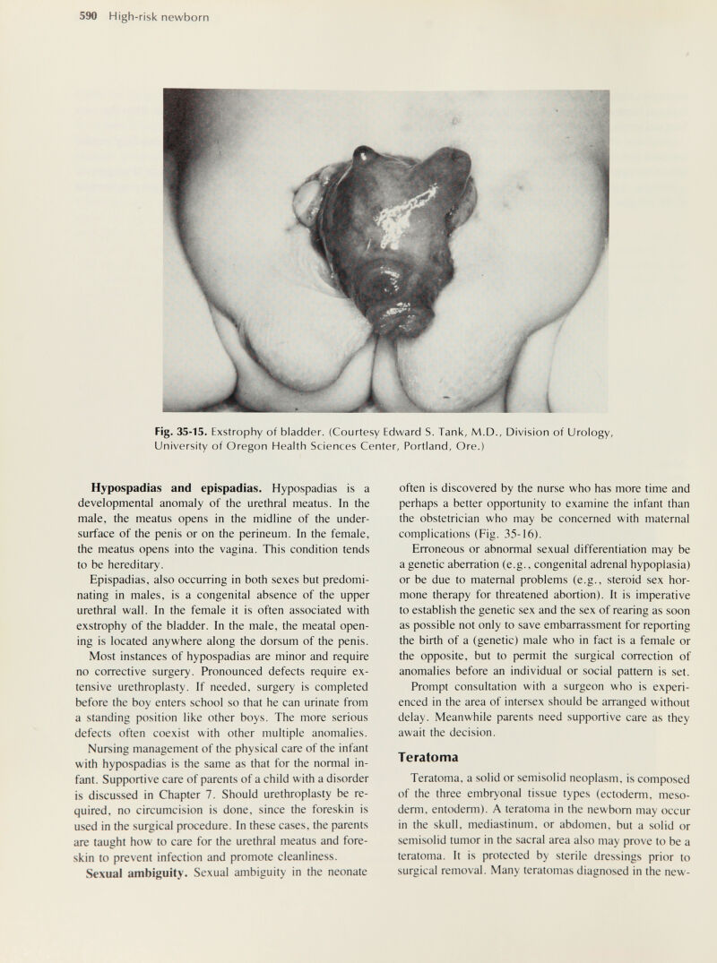 590 High-risk newborn Fig- 35-15. Exstrophy of bladder. (Courtesy Edward S. Tank, M.D., Division of Urology, University of Oregon Health Sciences Center, Portland, Ore.) Hypospadias and epispadias. Hypospadias is a developmental anomaly of the urethral meatus. In the male, the meatus opens in the midline of the under- surface of the penis or on the perineum. In the female, the meatus opens into the vagina. This condition tends to be hereditary. Epispadias, also occurring in both sexes but predomi¬ nating in males, is a congenital absence of the upper urethral wall. In the female it is often associated with exstrophy of the bladder. In the male, the meatal open¬ ing is located anywhere along the dorsum of the penis. Most instances of hypospadias are minor and require no corrective surgery. Pronounced defects require ex¬ tensive urethroplasty. If needed, surgery is completed before the boy enters school so that he can urinate from a standing position like other boys. The more serious defects often coexist with other multiple anomalies. Nursing management of the physical care of the infant with hypospadias is the same as that for the normal in¬ fant. Supportive care of parents of a child with a disorder is discussed in Chapter 7. Should urethroplasty be re¬ quired, no circumcision is done, since the foreskin is used in the surgical procedure. In these cases, the parents are taught how to care for the urethral meatus and fore¬ skin to prevent infection and promote cleanliness. Sexual ambiguity. Sexual ambiguity in the neonate often is discovered by the nurse who has more time and perhaps a better opportunity to examine the infant than the obstetrician who may be concerned with maternal complications (Fig. 35-16). Erroneous or abnormal sexual differentiation may be a genetic aberration (e.g., congenital adrenal hypoplasia) or be due to maternal problems (e.g., steroid sex hor¬ mone therapy for threatened abortion). It is imperative to establish the genetic sex and the sex of rearing as soon as possible not only to save embarrassment for reporting the birth of a (genetic) male who in fact is a female or the opposite, but to permit the surgical correction of anomalies before an individual or social pattern is set. Prompt consultation with a surgeon who is experi¬ enced in the area of intersex should be arranged without delay. Meanwhile parents need supportive care as they await the decision. Teratoma Teratoma, a solid or semisolid neoplasm, is composed of the three embryonal tissue types (ectoderm, meso¬ derm, entoderm). A teratoma in the newborn may occur in the skull, mediastinum, or abdomen, but a solid or semisolid tumor in the sacral area also may prove to be a teratoma. It is protected by sterile dressings prior to surgical removal. Many teratomas diagnosed in the new-