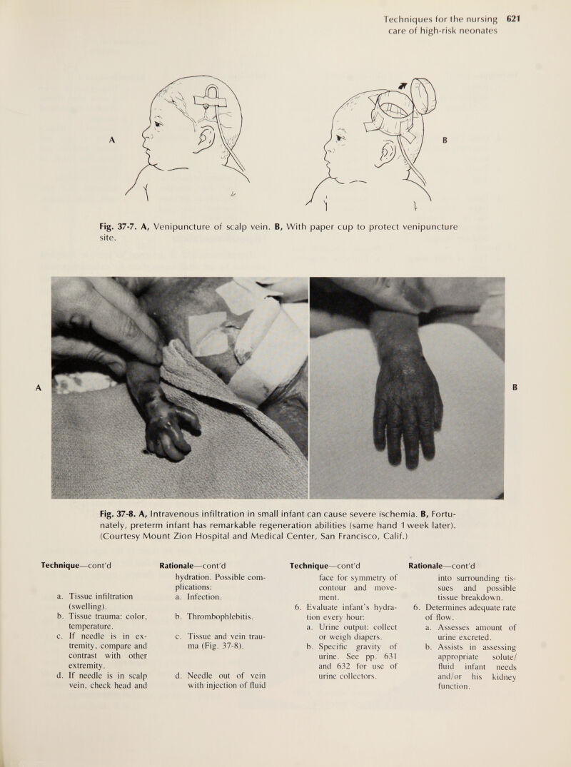 Techniques for the nursing 621 care of high-risk neonates Fig. 37-7. A, Venipuncture of scalp vein. B, With paper cup to protect venipuncture site. Fig. 37-8. A, Intravenous infiltration in small infant can cause severe ischemia. B, Fortu¬ nately, preterm infant has remarl<able regeneration abilities (same hand 1 week later). (Courtesy Mount Zion Hospital and Medical Center, San Francisco, Calif.) Technique—cont'd a. Tissue infiltration (swelling). b. Tissue trauma: color, temperature. c. If needle is in ex¬ tremity, compare and contrast with other extremity. d. If needle is in scalp vein, check head and Rationale—cont'd hydration. Possible com¬ plications; a. Infection. b. Thrombophlebitis. c. Tissue and vein trau¬ ma (Fig. 37-8). d. Needle out of vein with injection of fluid Technique—cont'd face for symmetry of contour and move¬ ment. 6. Evaluate infant's hydra¬ tion every hour: a. Urine output: collect or weigh diapers. b. Specific gravity of urine. See pp. 631 and 632 for use of urine collectors. Rationale—cont'd into surrounding tis¬ sues and possible tissue breakdown. 6. Determines adequate rate of flow. a. Assesses amount of urine excreted. b. Assists in assessing appropriate solute/ fluid infant needs and/or his kidney function.