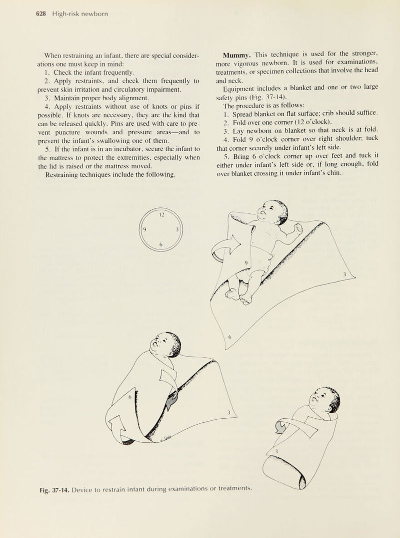 628 High-risk newborn When restraining an infant, there are special consider¬ ations one must keep in mind: 1. Check the infant frequently. 2. Apply restraints, and check them frequenüy to prevent skin irritation and circulatory impairment. 3. Maintain proper body alignment. 4. Apply restraints without use of knots or pins if possible. If knots are necessary, they are the kind that can be released quickly. Pins are used with care to pre¬ vent puncture wounds and pressure areas—and to prevent the infant's swallowing one of them. 5. If the infant is in an incubator, secure the infant to the mattress to protect the extremities, especially when the lid is raised or the mattress moved. Restraining techniques include the following. Mummy. This technique is used for the stronger, more vigorous newborn. It is used for examinations, treatments, or specimen collections that involve the head and neck. Equipment includes a blanket and one or two large safety pins (Fig. 37-14). The procedure is as follows; 1. Spread blanket on flat surface; crib should suffice. 2. Fold over one corner (12 o'clock). 3. Lay newborn on blanket so that neck is at fold. 4. Fold 9 o'clock corner over right shoulder; tuck that comer securely under infant's left side. 5. Bring 6 o'clock comer up over feet and tuck it either under infant's left side or, if long enough, fold over blanket crossing it under infant's chin. Fig. 37-14. Device to restrain infant during examinations or treatments.
