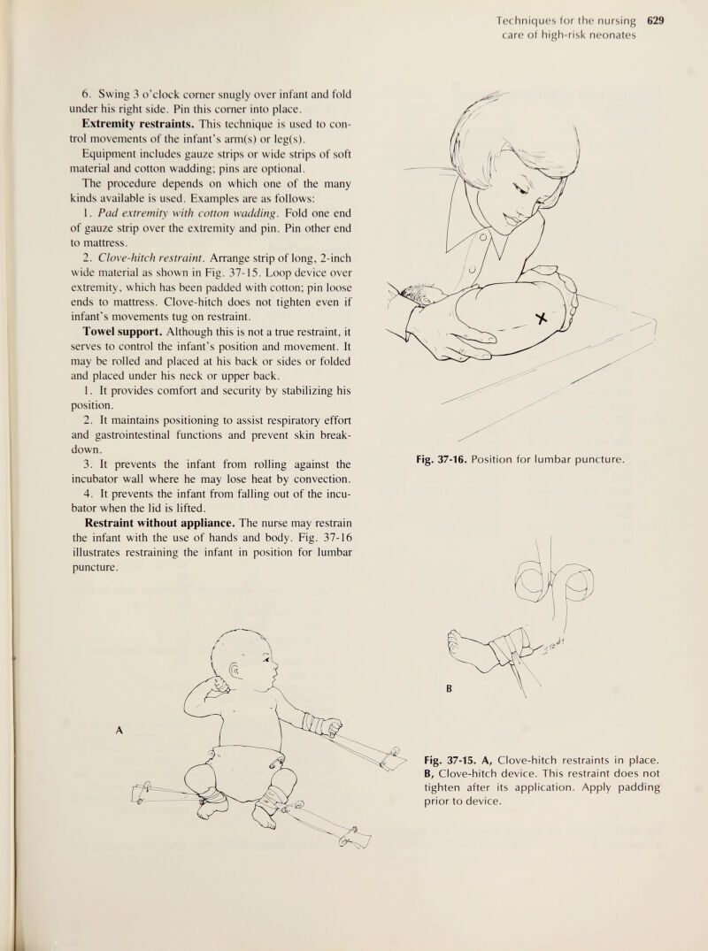 Techniques for the nursing 629 care of high-risk neonates 6. Swing 3 o'clock comer snugly over infant and fold under his right side. Pin this corner into place. Extremity restraints. This technique is used to con¬ trol movements of the infant's arm(s) or leg(s). Equipment includes gauze strips or wide strips of soft material and cotton wadding; pins are optional. The procedure depends on which one of the many kinds available is used. Examples are as follows: 1. Pad extremity with cotton wadding. Fold one end of gauze strip over the extremity and pin. Pin other end to mattress. 2. Clove-hitch restraint. Arrange strip of long, 2-inch wide material as shown in Fig. 37-15. Loop device over extremity, which has been padded with cotton; pin loose ends to mattress. Clove-hitch does not tighten even if infant's movements tug on restraint. Towel support. Although this is not a true restraint, it serves to control the infant's position and movement. It may be rolled and placed at his back or sides or folded and placed under his neck or upper back. 1. It provides comfort and security by stabilizing his position. 2. It maintains positioning to assist respiratory effort and gastrointestinal functions and prevent skin break¬ down. 3. It prevents the infant from rolling against the incubator wall where he may lose heat by convection. 4. It prevents the infant from falling out of the incu¬ bator when the lid is lifted. Restraint without appliance. The nurse may restrain the infant with the use of hands and body. Fig. 37-16 illustrates restraining the infant in position for lumbar puncture. Fig. 37-16. Position for lumbar puncture. Fig- 37-15. A, Clove-hitch restraints in place. B, Clove-hitch device. This restraint does not tighten after its application. Apply padding prior to device.