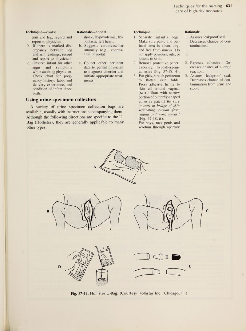 Techniques for the nursing 631 care of high-risk neonates Technique—cont'd arm and leg. record and report to physician. b. If there is marked dis¬ crepancy between leg and arm readings, record and report to physician. c. Observe infant for other signs and symptoms while awaiting physician. Check chart for preg¬ nancy history, labor and delivery experience, and condition of infant since birth. Rationale—cont'd shock, hypovolemia, hy¬ poplastic left heart. b. Suggests cardiovascular anomaly (e.g., coarcta¬ tion of aorta). c. Collect other pertinent data to permit physician to diagnose disorder and initiate appropriate treat¬ ments. Technique 1. Separate infant's legs. Make sure pubic and per¬ ineal area is clean, dry, and free from mucus. Do not apply powders, oils, or lotions to skin. 2. Remove protective paper, exposing hypoallergenic adhesive (Fig. 37-18, A). 3. For girls, stretch perineum to flatten skin folds. Press adhesive firmly to skin all around vagina. (note: Start with narrow portion of butterfly-shaped adhesive patch.) Be sure to start at bridge of skin separating rectum from vagina and work upward (Fig. 37-18, B). For boys, tuck penis and scrotum through aperture Rationale 1. Assures leakproof seal. Decreases chance of con¬ tamination. 2. Exposes adhesive. De¬ creases chance of allergic reaction. 3. Assures leakproof seal. Decreases chance of con¬ tamination from urine and stool. Using urine specimen collectors A variety of urine specimen collection bags are available, usually with instructions accompanying them. Although the following directions are specific to the U- Bag (Hollister), they are generally applicable to many other types: Fig- 37-18. Hollister U-Bag. (Courtesy Hollister Inc., Chicago, 111.)