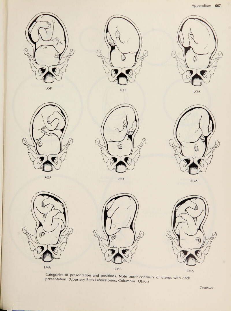 Appendixes 667 LMA RMP RMA Categories of presentation and positions. Note outer contours of uterus with each presentation. (Courtesy Ross Laboratories, Columbus, Ohio.) Continued.