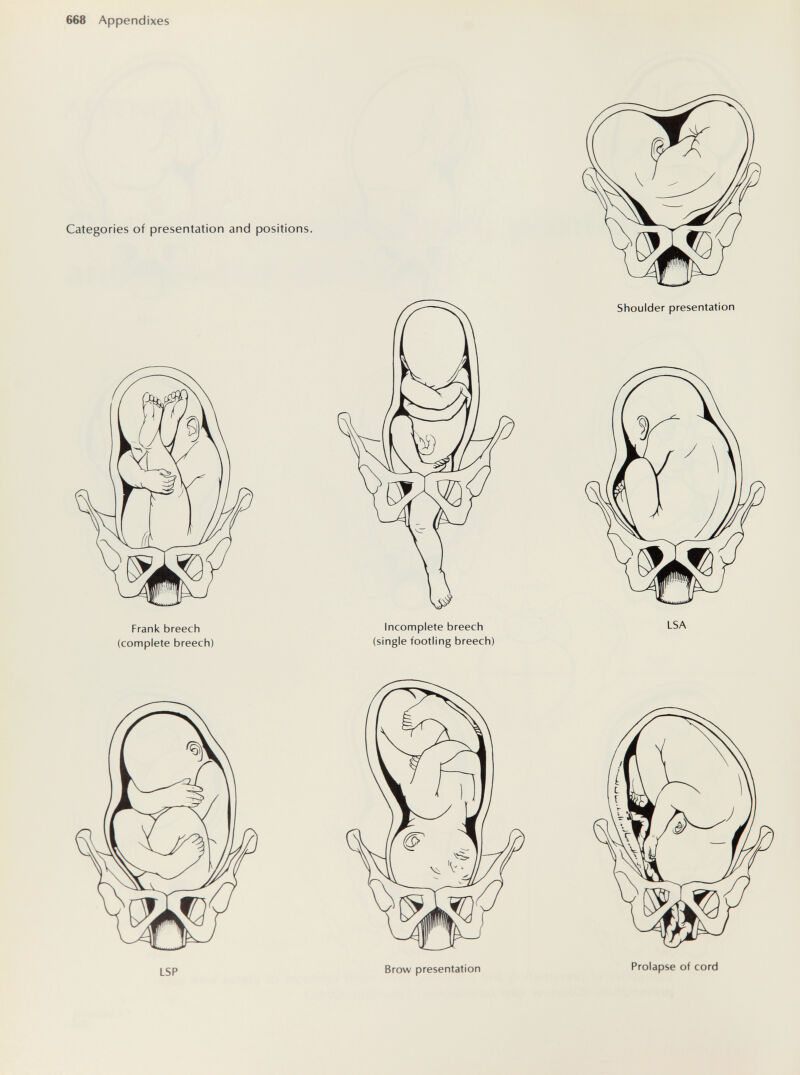 668 Appendixes Frank breech (complete breech) Incomplete breech (single footling breech) LSA LSP Brow presentation Prolapse of cord