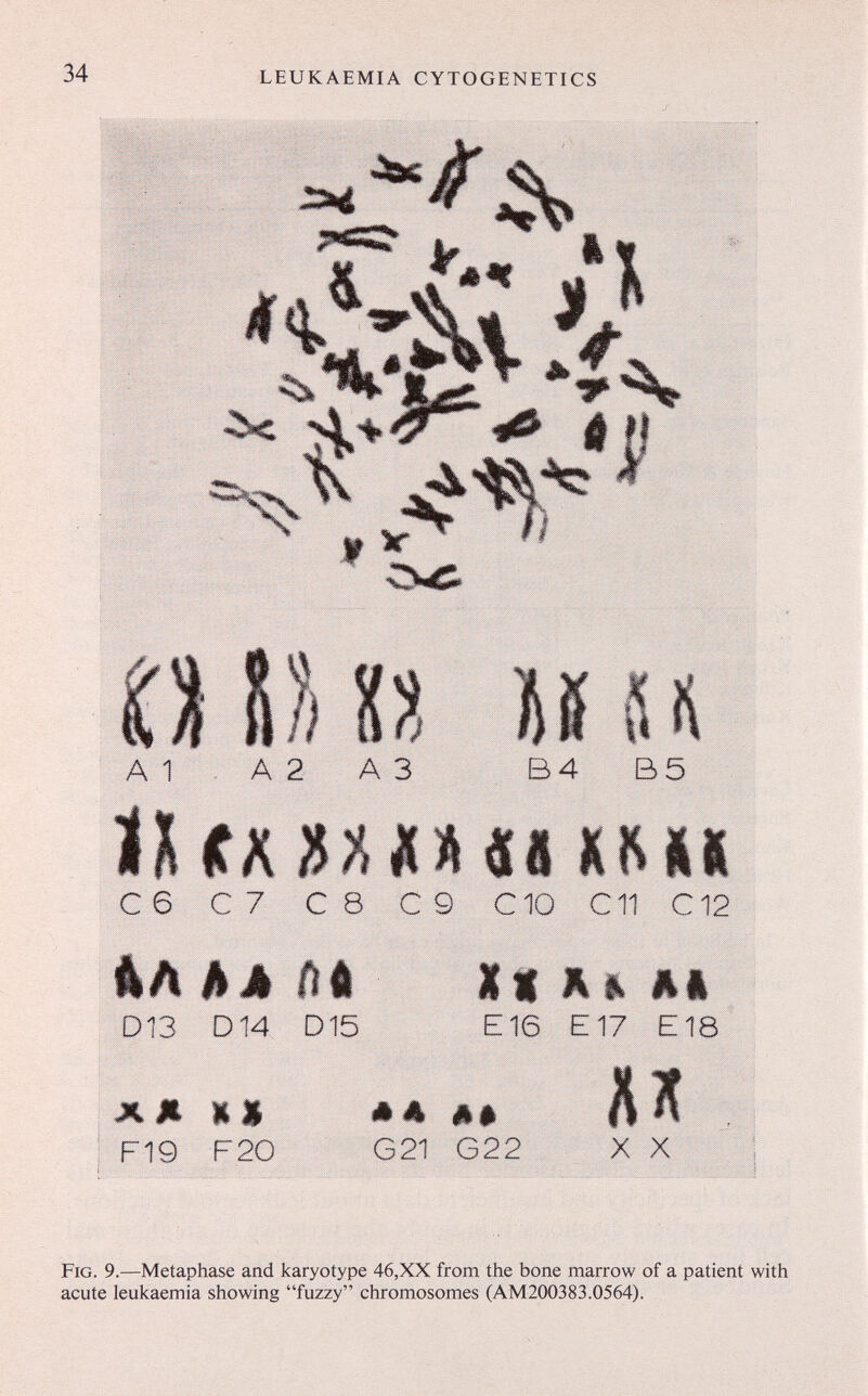 34 LEUKAEMIA CYTOGENETICS «íSc ^^5^' ií0^ ^ \ 9 * A 1 A 2 A3 B4 B5 CKUnu XKXt C6 с 7 С 8 С 9 СЮ С11 С12 Ikñ h А iiü D13 D14 D15 хд «» F19 F20 Xi Ai E16 E17 E18 *A A» G21 G22 X X Fig. 9.—Metaphase and karyotype 46,XX from the bone marrow of a patient with acute leukaemia showing fuzzy chromosomes (AM200383.0564).