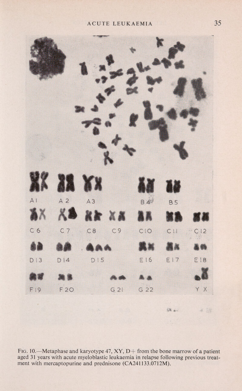 ACUTE LEUKAEMIA 35 lÉft W it %# m ^ w ж ш К# ^ ^•г f i 'H. I» А 2 A3 Ai ftir XI с 6 с ? с 8 С 9 il iá . étkê^ D 13 014 DÎ5 ÊÈ9 ШШ UPP. w4| F19 F20 G 21 С 12 •И E 18 ^ i Y X Fig. 10.—Metaphase and karyotype 47, XY, D+ from the bone marrow of a patient aged 31 years with acute myeloblastic leukaemia in relapse following previous treat¬ ment with mercaptopurine and prednisone (CA241133.0712M).