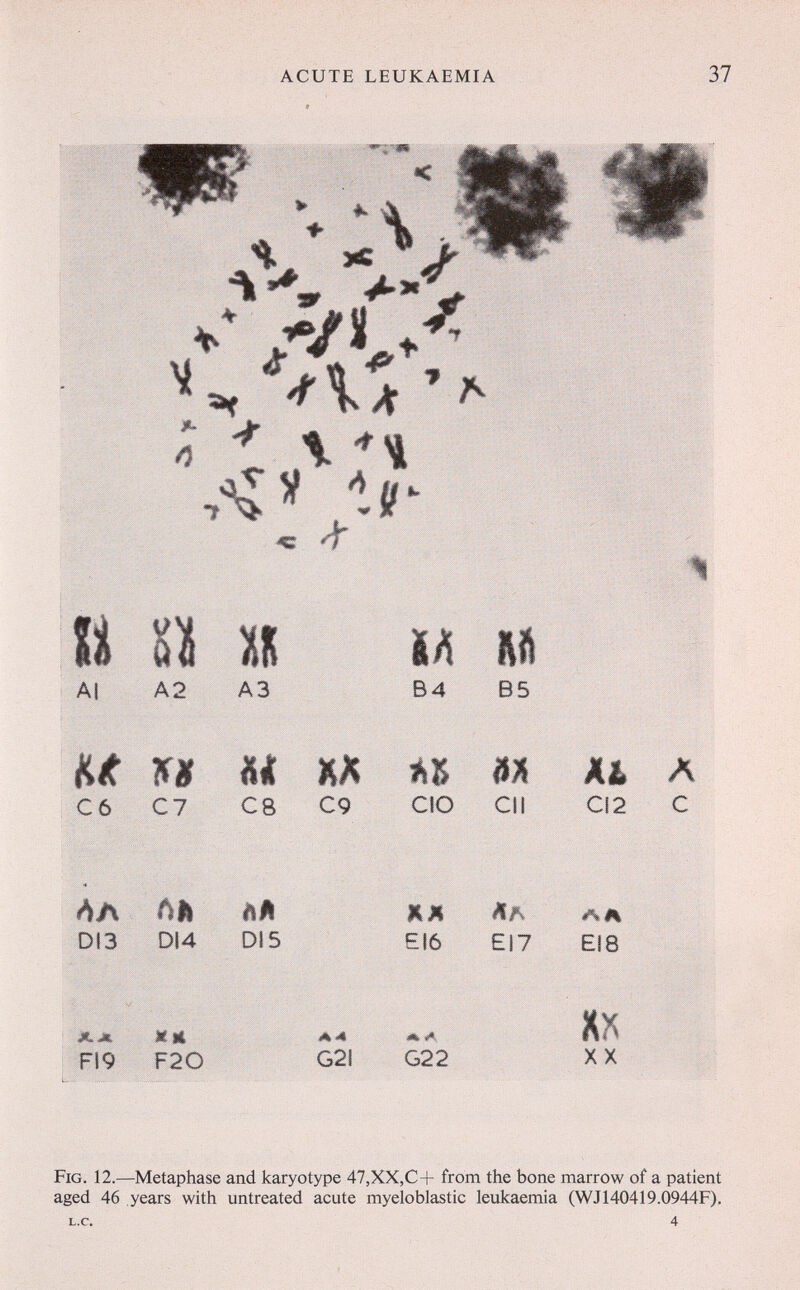 ACUTE LEUKAEMIA 37 ■ ♦ ^ îC ^ > Ук/^ -fX* 'A Л \ & Al и и A2 A3 ìa и В4 В5 Hit ifi и m m m Äb л С6 С7 С8 С9 СЮ СИ CI2 С пл DI3 Лй D14 àÂ Dl 5 ЛИ EI6 EI7 El 8 д. ж FI9 Шй F20 А<4 G2I G22 XX Fig. 12.-Metaphase and karyotype 47,XX,C+ from the bone of a patie^^^^ aged 46 years with untreated acute myeloblastic leukaemia (WJ140419.0944F). 4 L.C.