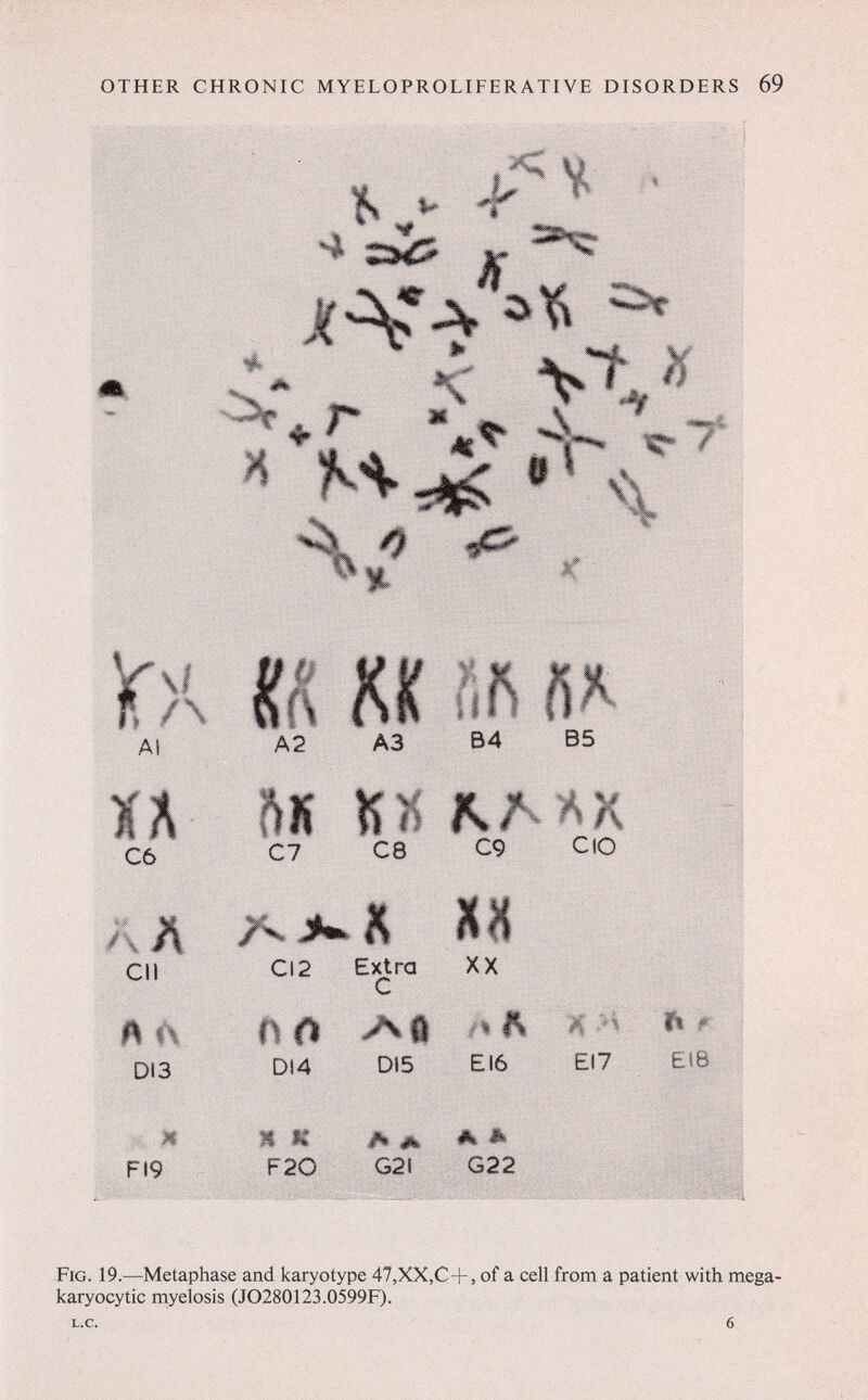 OTHER CHRONIC MYELOPROLIFERATIVE DISORDERS 69 m. Щ m ât JÊ w Hl jsß 3k n Ai К A2 A3 В4 В5 С6 С7 С8 С9 СЮ СИ DI3 CI2 Extra С Di4 DIS XX í% f E16 If 1*1; : m m El 7 EIS: FI9 ш m II» #1: À «к F20 G2l G22 Fig. 19.—Metaphase and karyotype 47,XX,C+, of a cell from a patient with mega- karyocytic rnyelosis (JO280123.0599F).