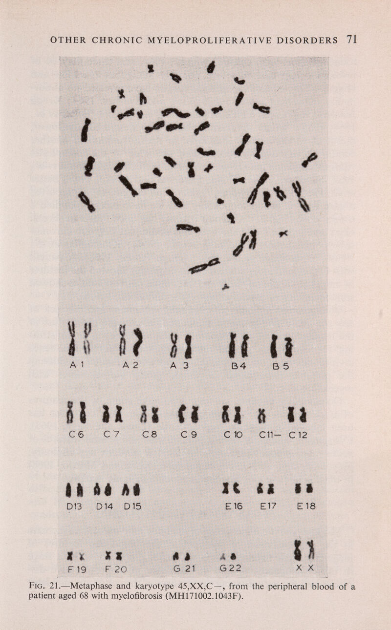 OTHER CHRONIC MYELOPROLIFERATIVE DISORDERS 71 .. Ш { '^fs к ^ % ^ fc i ^-\ - A % > A1 A2 A3 B4 B5 IS и II Cl II 8 il C6 C'7 C8 С 9 СЮ C11- C12 II AI AI D13 D14 D15 11 II Ì1 ЕШ E17 EIS F 19 ITI F 20 ê è G 21' â ê G22 X X Fig. 21.—Metaphase and karyotype 45,XX,G—, from the peripheral blood of a patient aged 68 with myelofibrosis (MH171002.1043F).