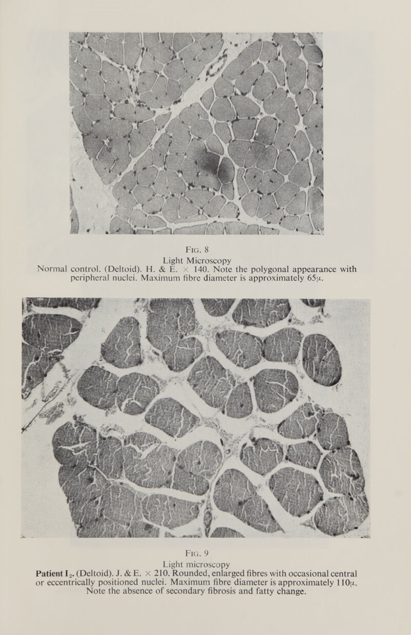 Fig. 8 Light Microscopy Normal control. (Deltoid). H. & E. x 140. Note the polygonal appearance with peripheral nuclei. Maximum fibre diameter is approximately 65[j.. Fig. 9 Light microscopy Patient I2. (Deltoid). J. & E. x 210. Rounded, enlarged fibres with occasional central or eccentrically positioned nuclei. Maximum fibre diameter is approximately llOjJi, Note the absence of secondary fibrosis and fatty change.