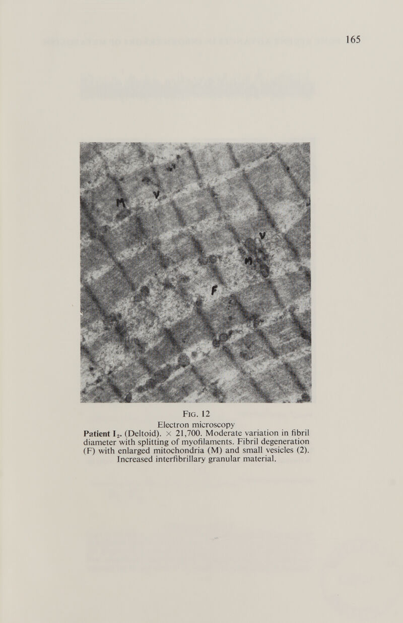 Fig. 12 Electron microscopy Patient I2. (Deltoid), x 21,700. Moderate variation in fibril diameter with splitting of myofilaments. Fibril degeneration (F) with enlarged mitochondria (M) and small vesicles (2). Increased interfibriilary granular material.