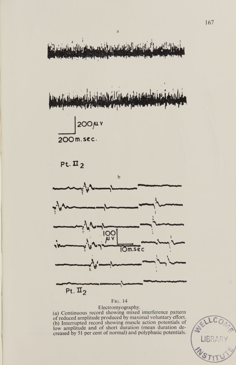 |200/U.Y 200m.s€c. Pt.n2 Pt.ir2 Fig. 14 Electromyography. (a) Continuous record showing mixed interference pattern of reduced amplitude produced by maximal voluntary effort. (b) Interrupted record showing muscle action potentials of low amplitude and of short duration (mean duration de¬ creased by 51 per cent of normal) and polyphasic potentials.