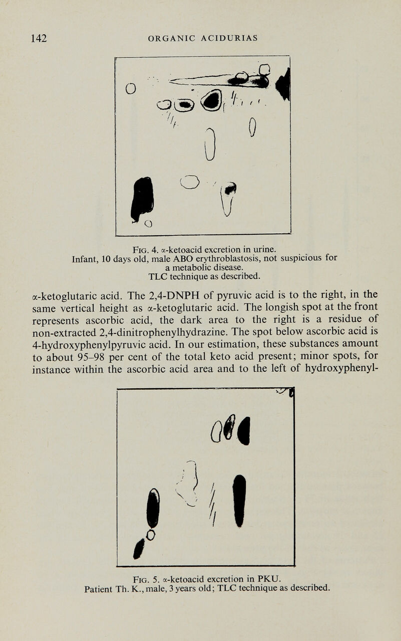 142 ORGANIC ACIDURIAS Fig. 4. «-ketoacid excretion in urine. Infant, 10 days old, male ABO erythroblastosis, not suspicious for a metabolic disease. TLC technique as described. a-ketoglutaric acid. The 2,4-DNPH of pyruvic acid is to the right, in the same vertical height as a-ketoglutaric acid. The longish spot at the front represents ascorbic acid, the dark area to the right is a residue of non-extracted 2,4-dinitrophenylhydrazine. The spot belovs^ ascorbic acid is 4-hydroxyphenylpyruvic acid. In our estimation, these substances amount to about 95-98 per cent of the total keto acid present; minor spots, for instance within the ascorbic acid area and to the left of hydroxyphenyl- — ^ f Fig. 5. a-ketoacid excretion in PKU. Patient Th. K.,male, 3 years old; TLC technique as described.