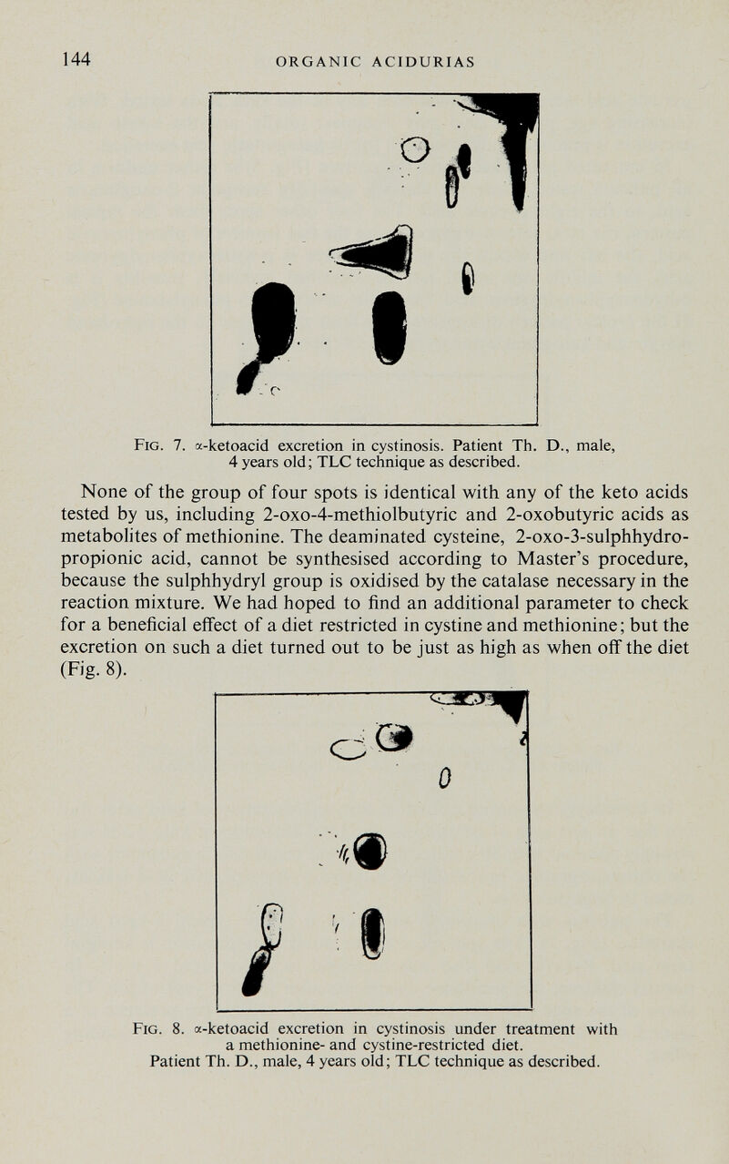 144 ORGANIC ACIDURIAS e Fig. 7. a-ketoacid excretion in cystinosis. Patient Th. D., male, 4 years old; TLC technique as described. None of the group of four spots is identical with any of the keto acids tested by us, including 2-oxo-4-methiolbutyric and 2-oxobutyric acids as metabolites of methionine. The deaminated cysteine, 2-oxo-3-sulphhydro- propionic acid, cannot be synthesised according to Master's procedure, because the sulphhydryl group is oxidised by the catalase necessary in the reaction mixture. We had hoped to find an additional parameter to check for a beneficial effect of a diet restricted in cystine and methionine; but the excretion on such a diet turned out to be just as high as when off the diet (Fig. 8). О & 0 Fig. 8. a-ketoacid excretion in cystinosis under treatment with a methionine- and cystine-restricted diet. Patient Th. D., male, 4 years old; TLC technique as described.