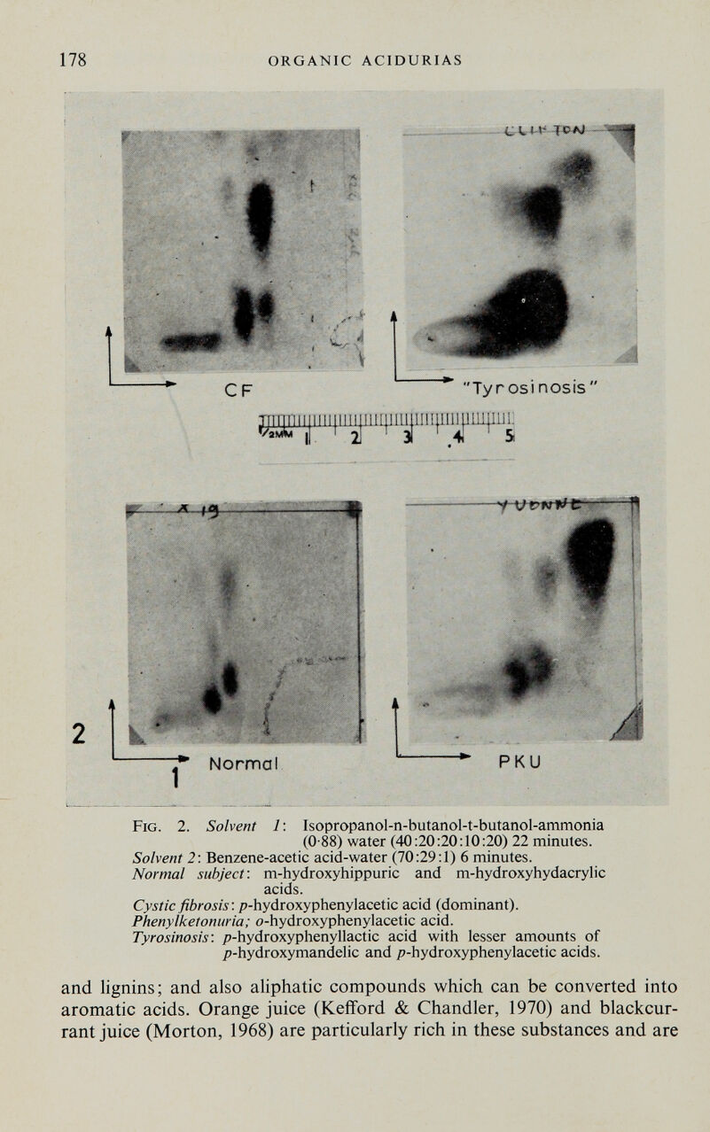 178 ORGANIC ACIDURIAS Fig. 2. Solvent 1 : Isopropanol-n-butanol-t-butanol-ammonia (0-88) water (40:20:20:10:20) 22 minutes. Solvent 2 ■. Benzene-acetic acid-water (70:29:1) 6 minutes. Normal subject: m-hydroxyhippuric and m-hydroxyhydacrylic acids. Cystic fibrosis: p-hydroxyphenylacetic acid (dominant). Phenylketonuria; o-hydroxyphenylacetic acid. Tyrosinosis: p-hydroxyphenyllactic acid with lesser amounts of /7-hydroxymandelic and p-hydroxyphenylacetic acids. and lignins; and also aliphatic compounds which can be converted into aromatic acids. Orange juice (Kefford & Chandler, 1970) and blackcur¬ rant juice (Morton, 1968) are particularly rich in these substances and are