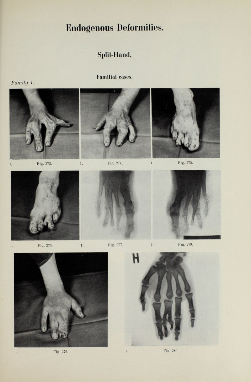 Endogenous Deformities Family 1. Fig. 27G. Split-IIand. Fig. 275. Familial cases. Fig. 274. Fig. 278. Fig. 28(1.