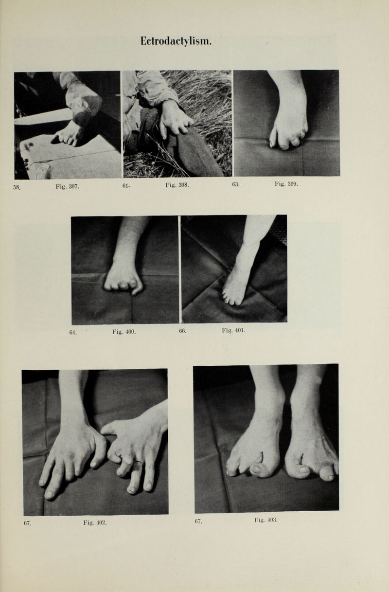 Ectrodactylism, 64. Fig. 400. 66. Fig. 401.