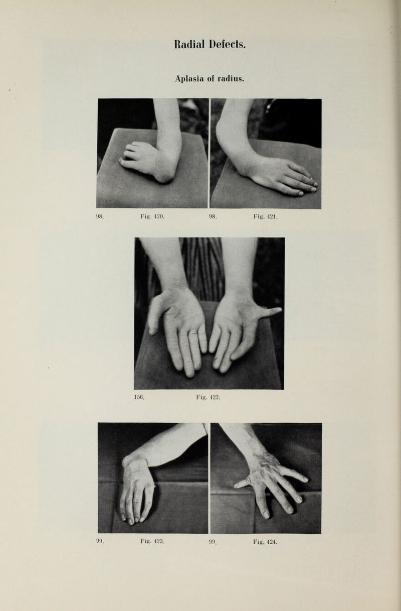 Radial Defects. Aplasia oí radius. P í . ' < 98. Fig. 420. 98. Fig. 421. Fig. 422. 99. Fig. 423. 99. Fig. 424.