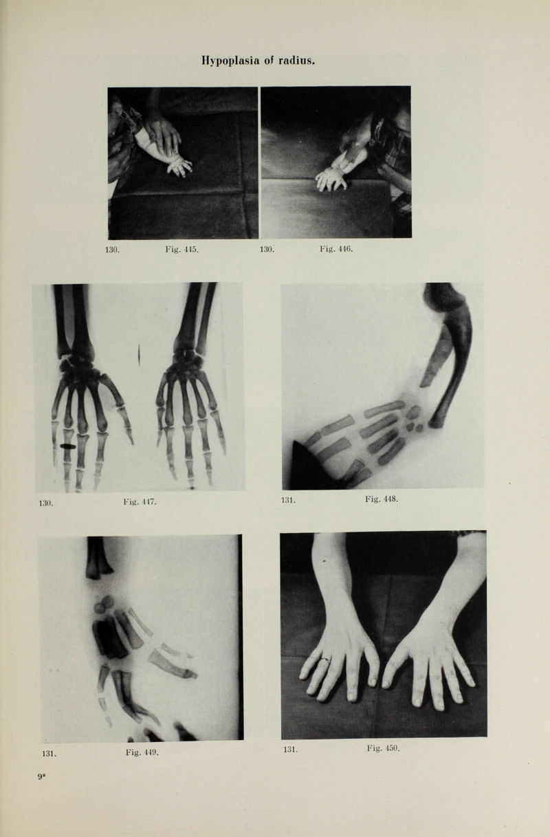 Hypoplasia of radius.
