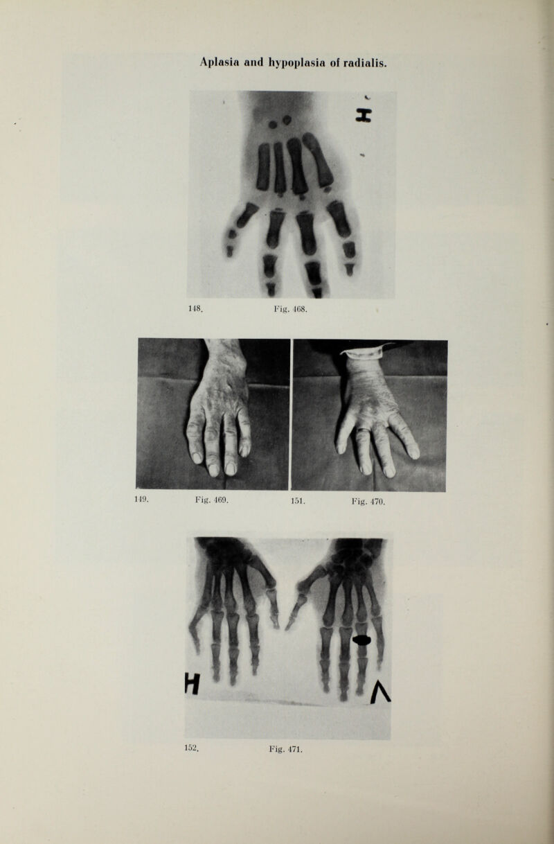 Aplasia and hypoplasia of radialis. 118. Fig. 468. Fig. 469. 151. Fig. 470. 152. Fig. 471.