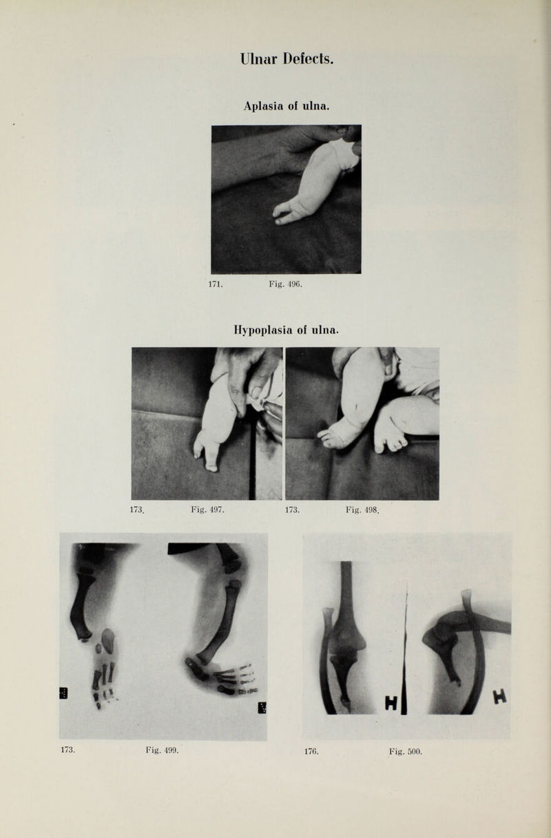 Ulnar Defects. Aplasia oí ulna. 171. Fig. 49C. Hypoplasia of ulna. 173. Fig. 499. 170. Fig. 500.