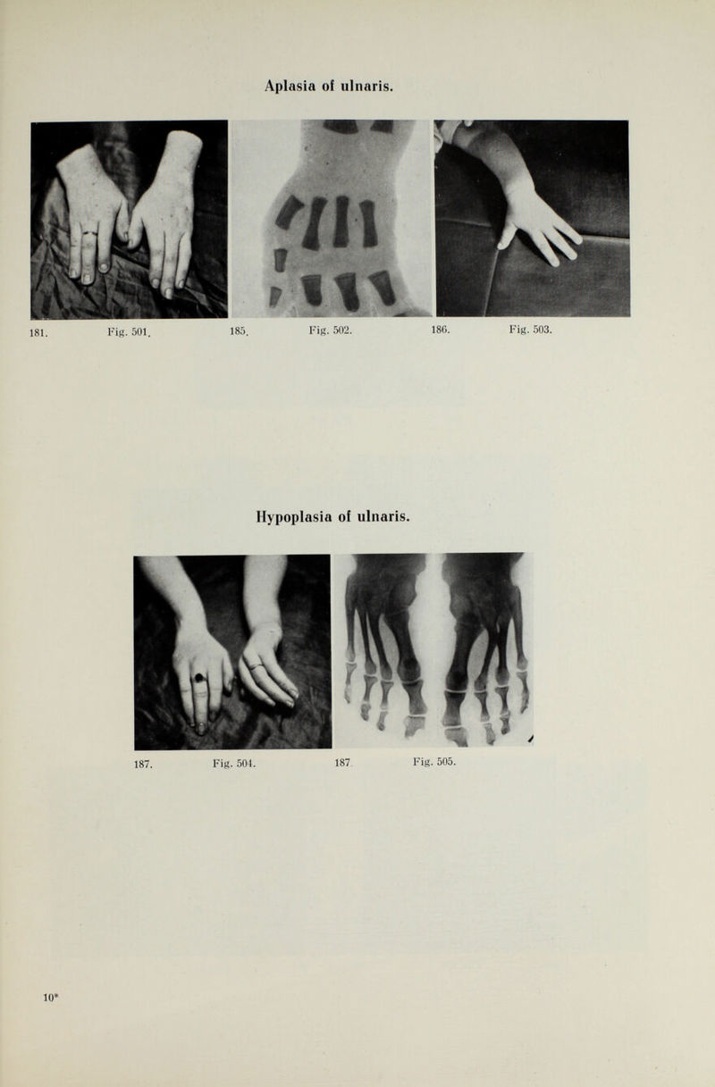 Aplasia of ulnaris. B l f Mmm ß- 1 f/n «m ÉS Ü«! » 11\ II *• w 181. Fig. 501. 185. Fig. 502. 18G. Fig. 503. Hypoplasia of ulnaris. 187. Fig. 504. 187 Fig. 505.
