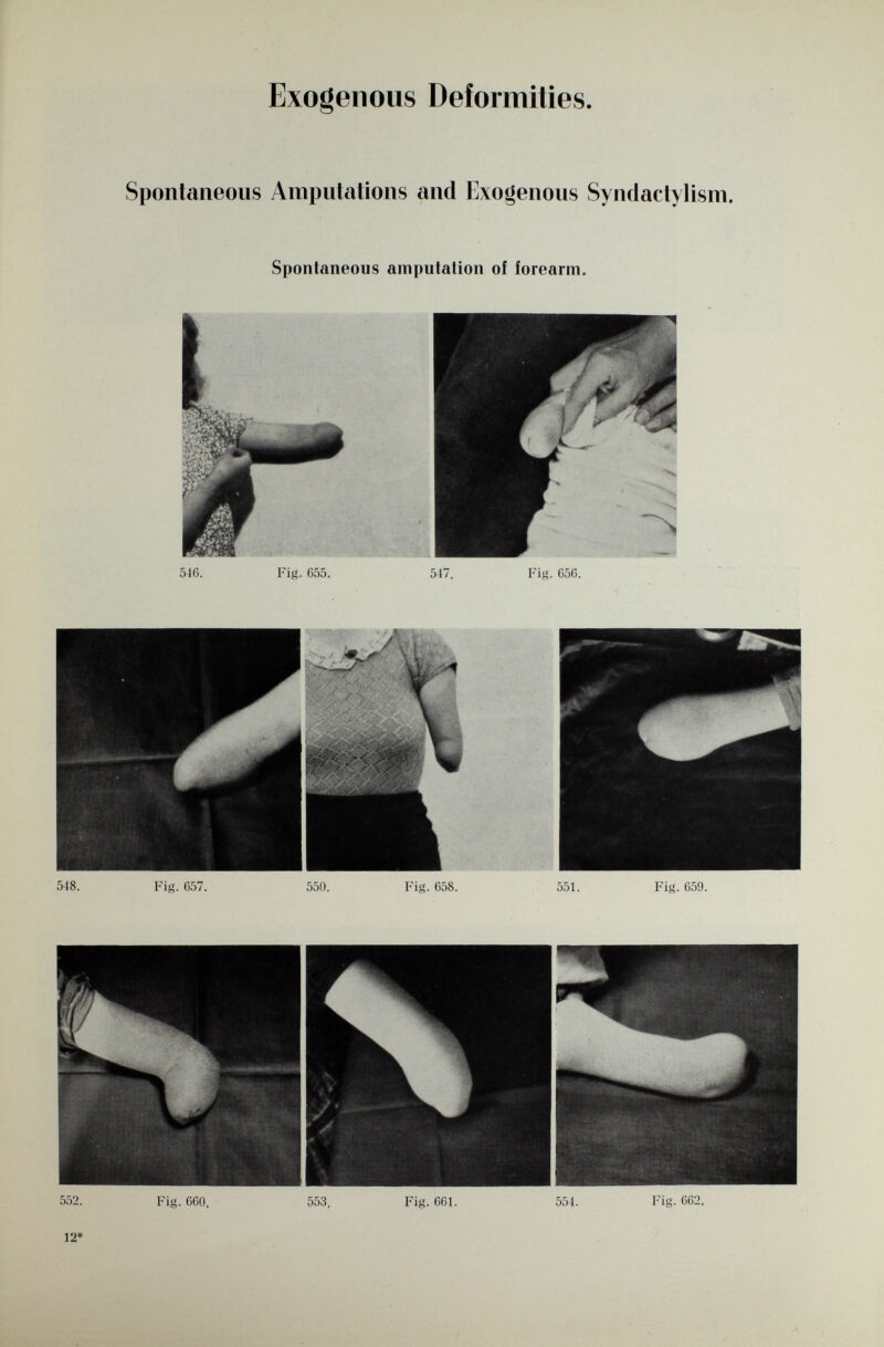 Exogenous Deformities Spontaneous Amputations and Exogenous Syndactylism. Spontaneous amputation of forearm. 546. Fig. 655. 517. Fig. 656.