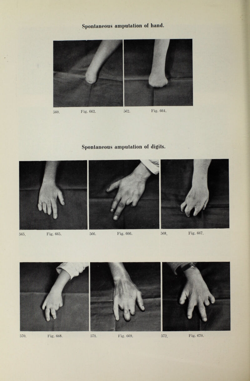 Spontaneous amputation of hand. 560. Fig. G63. 562. Fig. 661. Spontaneous amputation of digits. 57 °- Fig. 668. 571. Fig. 669. 572. Fig. 670.