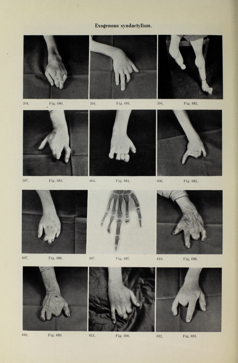 Exogenous syndactylism.