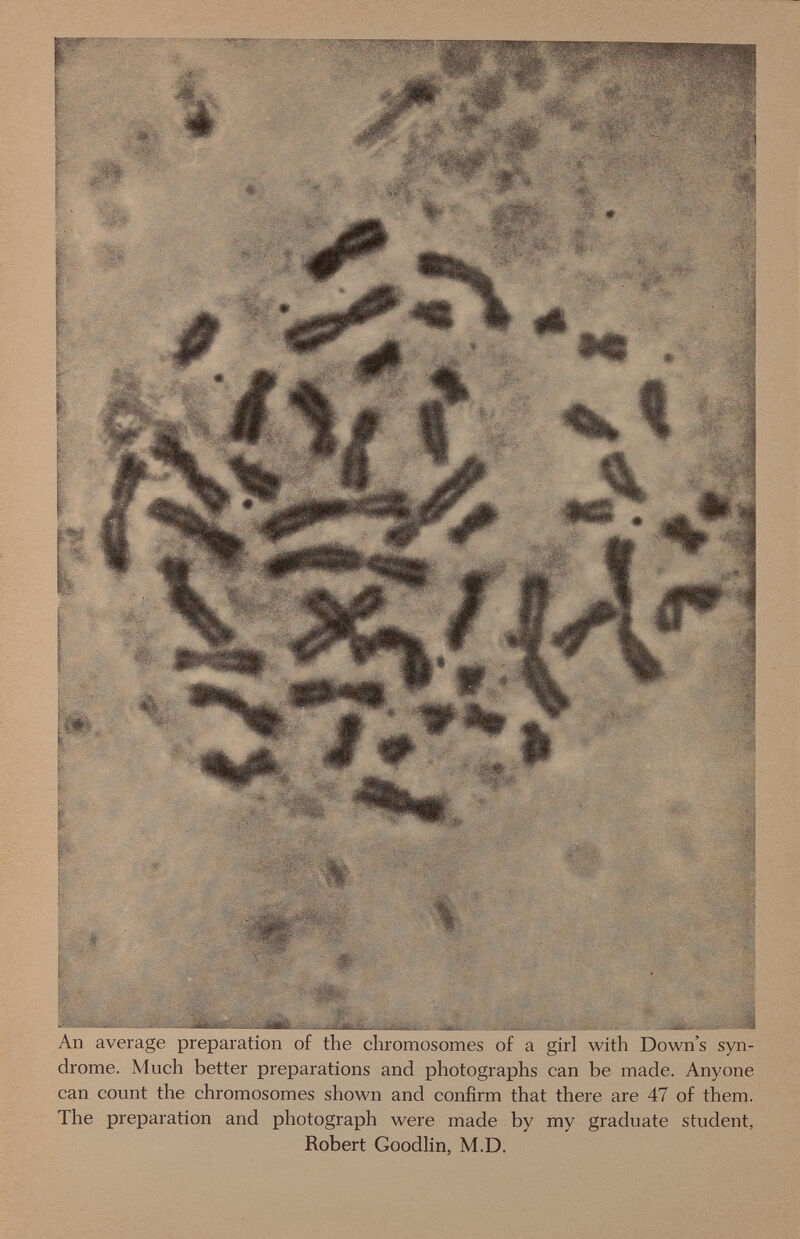 An average preparation of the chromosomes of a girl with Down's syn¬ drome. Much better preparations and photographs can be made. Anyone can count the chromosomes shown and confirm that there are 47 of them. The preparation and photograph were made by my graduate student, Robert Goodlin, M.D.