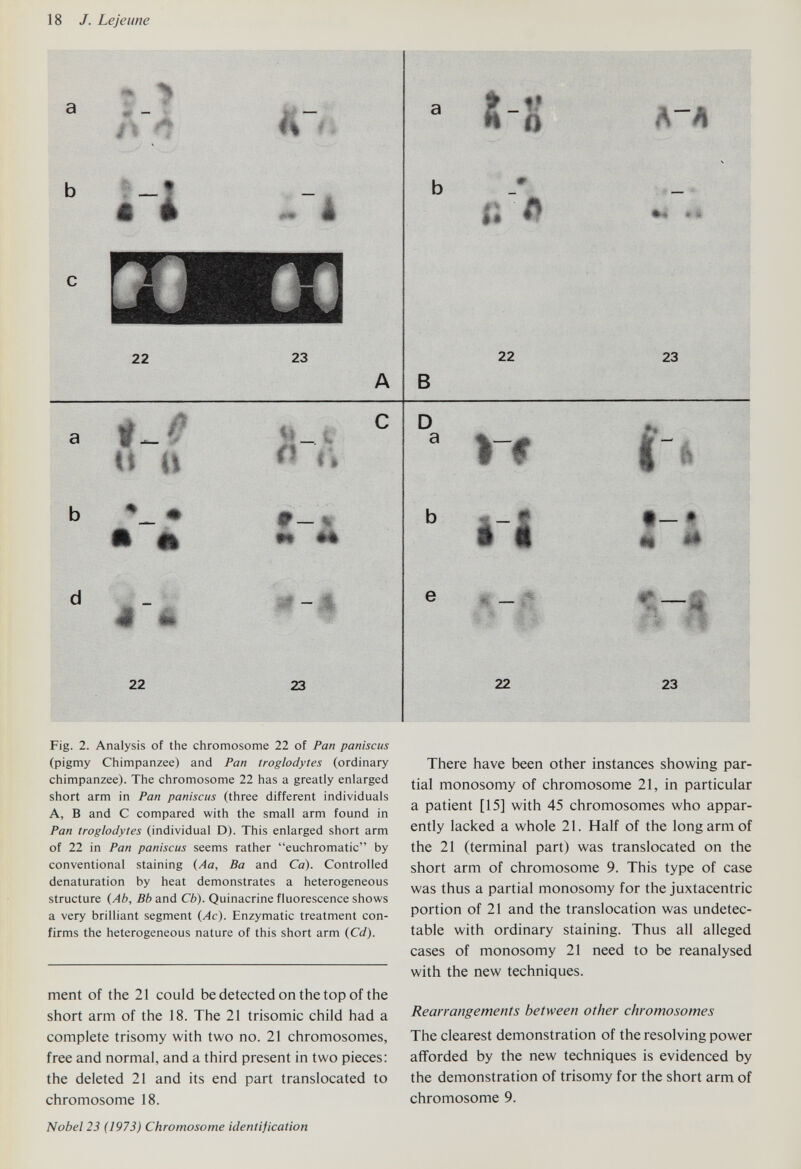 18 J. Lejeune Ж t M' 22 23 A m 22 23 В 22 23 Fig. 2. Analysis of the chromosome 22 of Pan paniscus (pigmy Chimpanzee) and Pan troglodytes (ordinary chimpanzee). The chromosome 22 has a greatly enlarged short arm in Pan paniscus (three different individuals A, В and С compared with the small arm found in Pan troglodytes (individual D). This enlarged short arm of 22 in Pan paniscus seems rather euchromatic by conventional staining (Aa, Ba and Ca). Controlled denaturation by heat demonstrates a heterogeneous structure {Ab, Bb and Cb). Quinacrine fluorescence shows a very brilliant segment (Ac). Enzymatic treatment con¬ firms the heterogeneous nature of this short arm (Cd). ment of the 21 could be detected on the top of the short arm of the 18. The 21 trisomie child had a complete trisomy with two no. 21 chromosomes, free and normal, and a third present in two pieces: the deleted 21 and its end part translocated to chromosome 18. D a M 22 23 There have been other instances showing par¬ tial monosomy of chromosome 21, in particular a patient [15] with 45 chromosomes who appar¬ ently lacked a whole 21. Half of the long arm of the 21 (terminal part) was translocated on the short arm of chromosome 9. This type of case was thus a partial monosomy for the juxtacentric portion of 21 and the translocation was undetec¬ table with ordinary staining. Thus all alleged cases of monosomy 21 need to be reanalysed with the new techniques. Rearrangements between other chromosomes The clearest demonstration of the resolving power afforded by the new techniques is evidenced by the demonstration of trisomy for the short arm of chromosome 9. Nobel 23 (1973) Chromosome identification