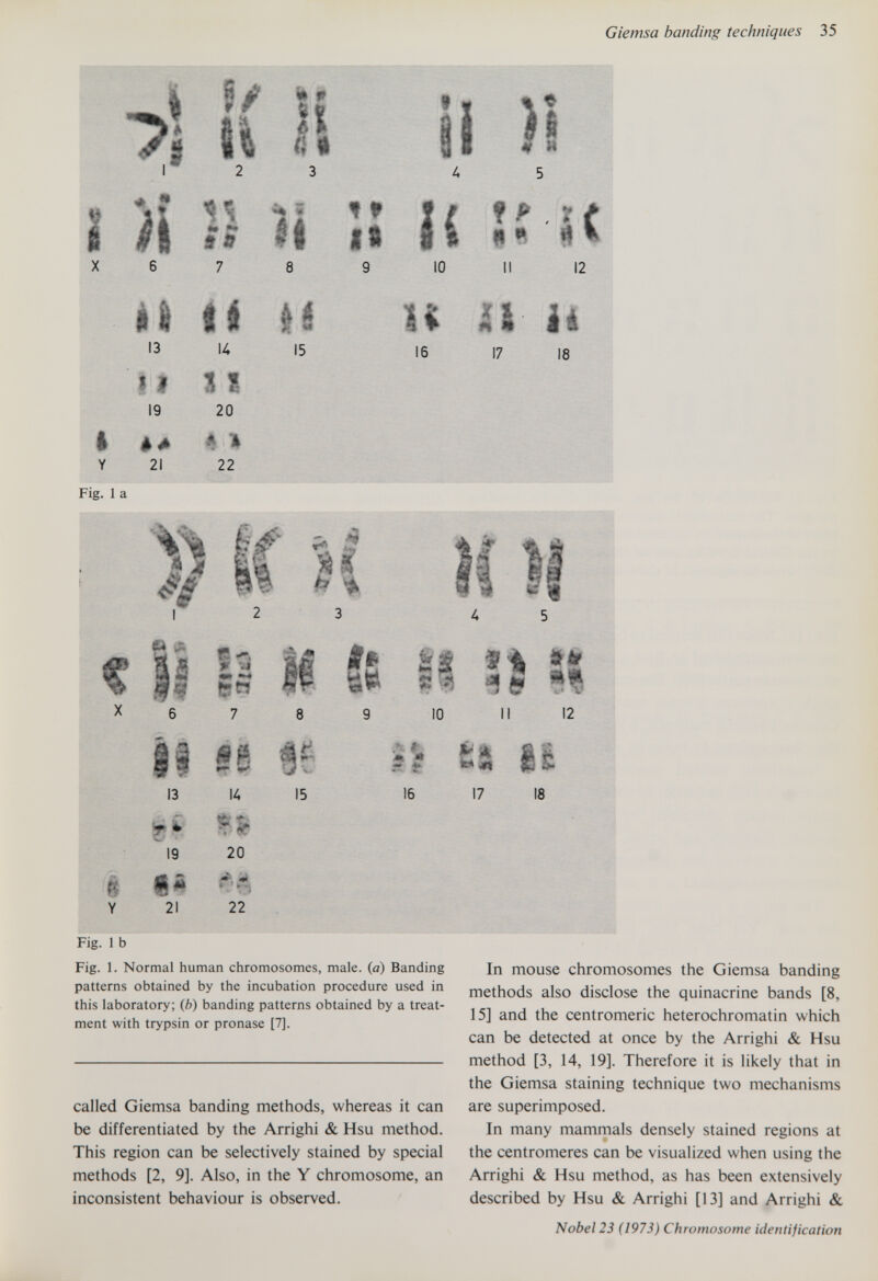 Giemsa banding techniques 35 7 I Y Fig. 1 a 13 II 19 21 13 fe* 19 21 li ч id f f li 4P i ( 12 К S 1 20 êH 22 15 U Д& li 16 17 18 u» Il IO li 12 SB 14 fe t- 20 * >, » 22 Il Il 15 16 17 18 Fig. 1 b Fig. 1. Normal human chromosomes, male, (a) Banding patterns obtained by the incubation procedure used in this laboratory; (b) banding patterns obtained by a treat¬ ment with trypsin or pronase [7]. called Giemsa banding methods, whereas it can be differentiated by the Arrighi & Hsu method. This region can be selectively stained by special methods [2, 9]. Also, in the Y chromosome, an inconsistent behaviour is observed. In mouse chromosomes the Giemsa banding methods also disclose the quinacrine bands [8, 15] and the centromeric heterochromatin which can be detected at once by the Arrighi & Hsu method [3, 14, 19]. Therefore it is likely that in the Giemsa staining technique two mechanisms are superimposed. In many mammals densely stained regions at the centromeres can be visualized when using the Arrighi & Hsu method, as has been extensively described by Hsu & Arrighi [13] and Arrighi & Nobel 23 (1973) Chromosome identification