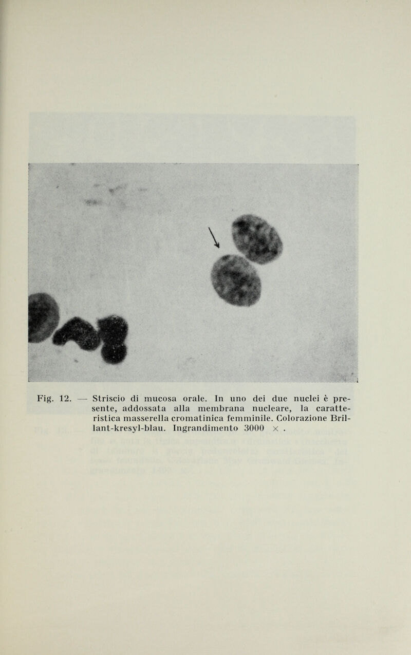 Fig. 12. — Striscio di mucosa orale. In uno dei due nuclei è pre¬ sente, addossata alla membrana nucleare, la caratte¬ ristica masserella cromatinica femminile. Colorazione Bril- lant-kresyl-blau. Ingrandimento 3000 x .