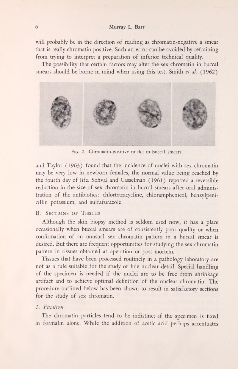 8 Murray L. Barr will probably be in the direction of reading as chromatin-negative a smear that is really chromatin-positive. Such an error can be avoided by refraining from trying to interpret a preparation of inferior technical quality. The possibility that certain factors may alter the sex chromatin in buccal smears should be borne in mind when using this test. Smith et al. (19б2) Fig. 2. Chromatin-positive nuclei in buccal smears. and Taylor (1963) found that the incidence of nuclei with sex chromatin may be very low in newborn females, the normal value being reached by the fourth day of life. Sohval and Casselman (1961) reported a reversible reduction in the size of sex chromatin in buccal smears after oral adminis¬ tration of the antibiotics: Chlortetracycline, chloramphenicol, benzylpeni- cillin potassium, and sulfafurazole. B. Sections of Tissues Although the skin biopsy method is seldom used now, it has a place occasionally when buccal smears are of consistently poor quality or when confirmation of an unusual sex chromatin pattern in a buccal smear is desired. But there are frequent opportunities for studying the sex chromatin pattern in tissues obtained at operation or post mortem. Tissues that have been processed routinely in a pathology laboratory are not as a rule suitable for the study of fine nuclear detail. Special handling of the specimen is needed if the nuclei are to be free from shrinkage artifact and to achieve optimal definition of the nuclear chromatin. The procedure outlined below has been shown to result in satisfactory sections for the study of sex chromatin. 1. Fixation The chromatin particles tend to be indistinct if the specimen is fixed in formalin alone. While the addition of acetic acid perhaps accentuates