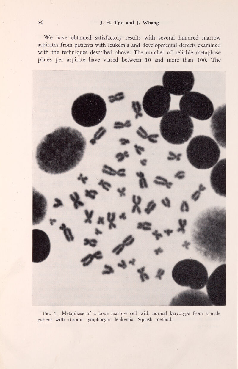 54 J. H. Tjio and J. Whang We have obtained satisfactory results with several hundred marrow aspirates from patients with leukemia and developmental defects examined with the techniques described above. The number of reliable metaphase plates per aspirate have varied between 10 and more than 100. The iit. -Ш Fig. 1. Metaphase of a bone marrow cell with normal karyotype from a male patient with chronic lymphocytic leukemia. Squash method.