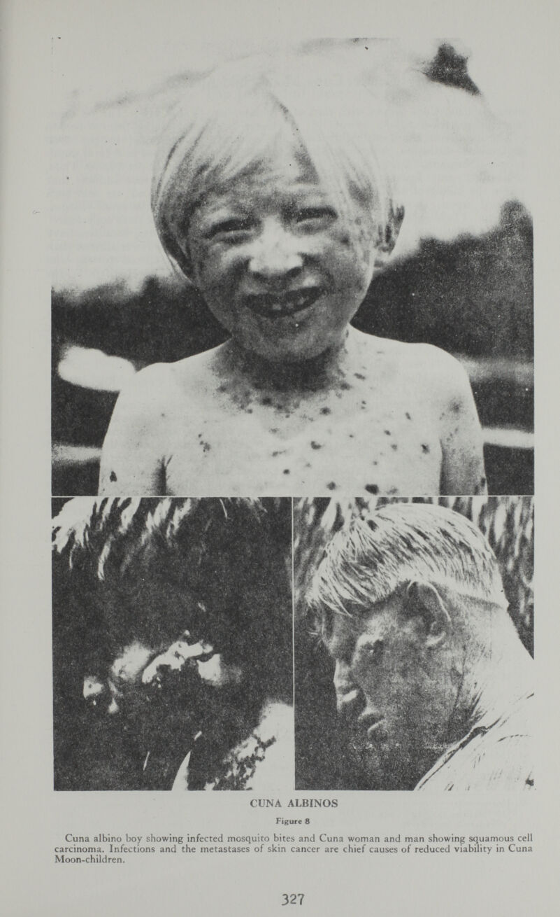 CUNA ALBINOS Figure 8 Cuna albino boy showing infected mosquito bites and Cuna woman and man showing squamous cell carcinoma. Infections and the metastases of skin cancer are chief causes of reduced viability in Cuna Moon-children. 327