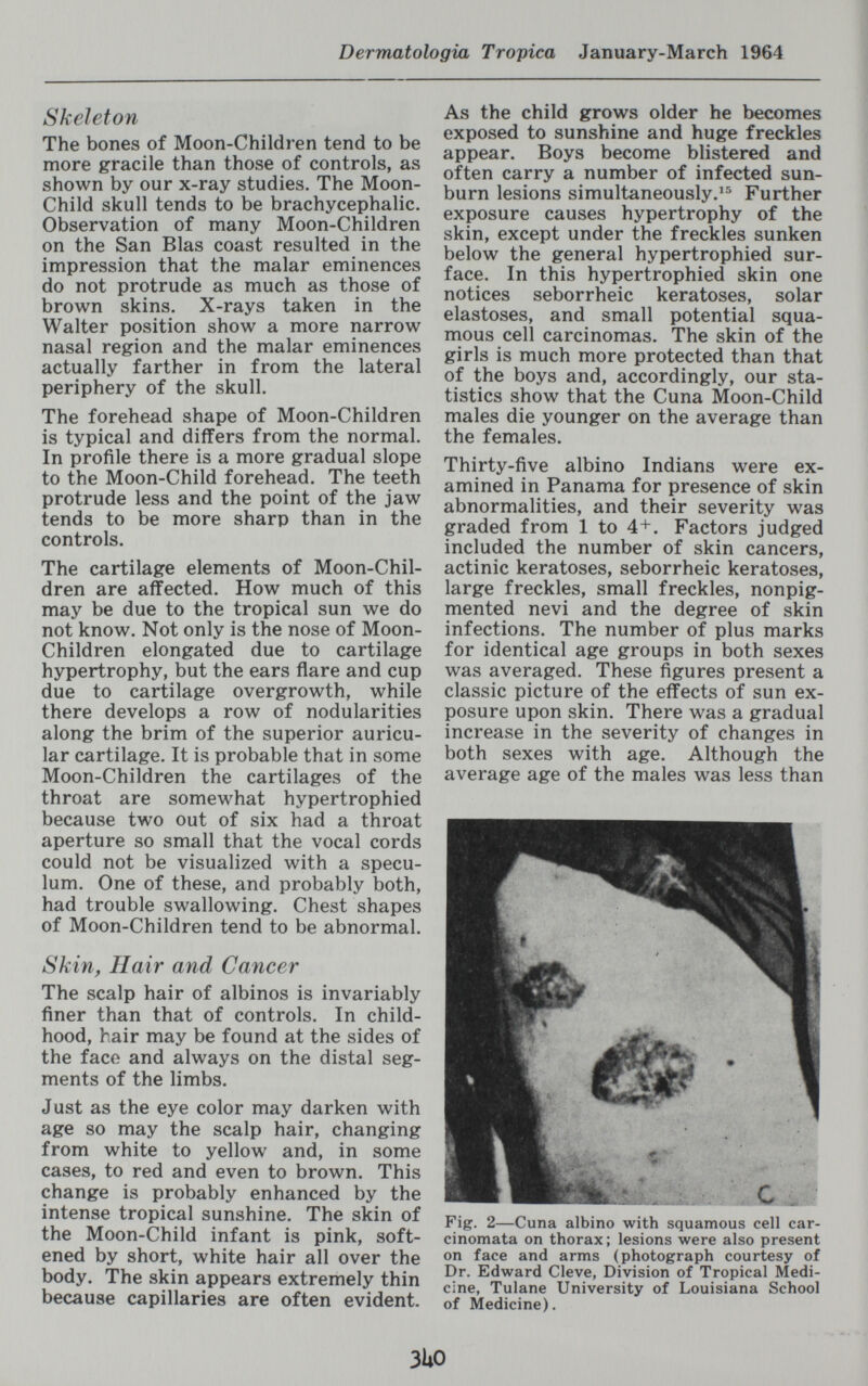 Dermatologia Tropica January-March 1964 Skeleton The bones of Moon-Children tend to be more gracile than those of controls, as shown by our x-ray studies. The Moon- Child skull tends to be brachycephalic. Observation of many Moon-Children on the San Bias coast resulted in the impression that the malar eminences do not protrude as much as those of brown skins. X-rays taken in the Walter position show a more narrow nasal region and the malar eminences actually farther in from the lateral periphery of the skull. The forehead shape of Moon-Children is typical and differs from the normal. In profile there is a more gradual slope to the Moon-Child forehead. The teeth protrude less and the point of the jaw tends to be more sharp than in the controls. The cartilage elements of Moon-Chil¬ dren are affected. How much of this may be due to the tropical sun we do not know. Not only is the nose of Moon- Children elongated due to cartilage hypertrophy, but the ears flare and cup due to cartilage overgrowth, while there develops a row of nodularities along the brim of the superior auricu¬ lar cartilage. It is probable that in some Moon-Children the cartilages of the throat are somewhat hypertrophied because two out of six had a throat aperture so small that the vocal cords could not be visualized with a specu¬ lum. One of these, and probably both, had trouble swallowing. Chest shapes of Moon-Children tend to be abnormal. Skin, Hair and Cancer The scalp hair of albinos is invariably finer than that of controls. In child¬ hood, hair may be found at the sides of the face and always on the distal seg¬ ments of the limbs. Just as the eye color may darken with age so may the scalp hair, changing from white to yellow and, in some cases, to red and even to brown. This change is probably enhanced by the intense tropical sunshine. The skin of the Moon-Child infant is pink, soft¬ ened by short, white hair all over the body. The skin appears extremely thin because capillaries are often evident. As the child grows older he becomes exposed to sunshine and huge freckles appear. Boys become blistered and often carry a number of infected sun¬ burn lesions simultaneously.^'' Further exposure causes hypertrophy of the skin, except under the freckles sunken below the general hypertrophied sur¬ face. In this hypertrophied skin one notices seborrheic keratoses, solar elastoses, and small potential squa¬ mous cell carcinomas. The skin of the girls is much more protected than that of the boys and, accordingly, our sta¬ tistics show that the Cuna Moon-Child males die younger on the average than the females. Thirty-five albino Indians were ex¬ amined in Panama for presence of skin abnormalities, and their severity was graded from 1 to 4+. Factors judged included the number of skin cancers, actinic keratoses, seborrheic keratoses, large freckles, small freckles, nonpig- mented nevi and the degree of skin infections. The number of plus marks for identical age groups in both sexes was averaged. These figures present a classic picture of the effects of sun ex¬ posure upon skin. There was a gradual increase in the severity of changes in both sexes with age. Although the average age of the males was less than Fig. 2—Cuna albino with squamous cell car- cinomata on thorax; lesions were also present on face and arms (photograph courtesy of Dr. Edward Cleve, Division of Tropical Medi¬ cine, Tulane University of Louisiana School of Medicine). 3U0