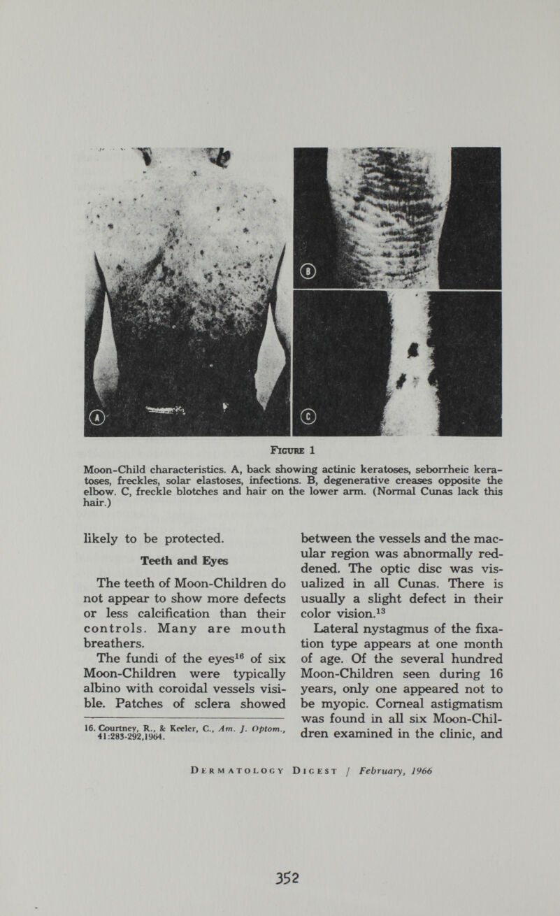 figure 1 Moon-Child characteristics. A, back showing actinic keratoses, seborrheic kera¬ toses, freckles, solar elastoses, infections. B, degenerative creases opposite the elbow. C, freckle blotches and hair on the lower arm. (Normal Cunas lack this hair.) likely to be protected. Teeth and Eyes The teeth of Moon-Children do not appear to show more defects or less calcification than their controls. Many are mouth breathers. The fundi of the eyes^® of six Moon-Children were typically albino with coroidal vessels visi¬ ble. Patches of sclera showed 16. Courtney, R., & Keeler, C., Am. I. Optom., 41:283-292,1904. between the vessels and the mac¬ ular region was abnormally red¬ dened. The optic disc was vis¬ ualized in all Cunas. There is usually a slight defect in their color vision. Lateral nystagmus of the fixa¬ tion type appears at one month of age. Of the several himdred Moon-Children seen during 16 years, only one appeared not to be myopic. Corneal astigmatism was found in all six Moon-Chil¬ dren examined in the clinic, and DtRMATOLOCY Digest / February, 1966 3S2