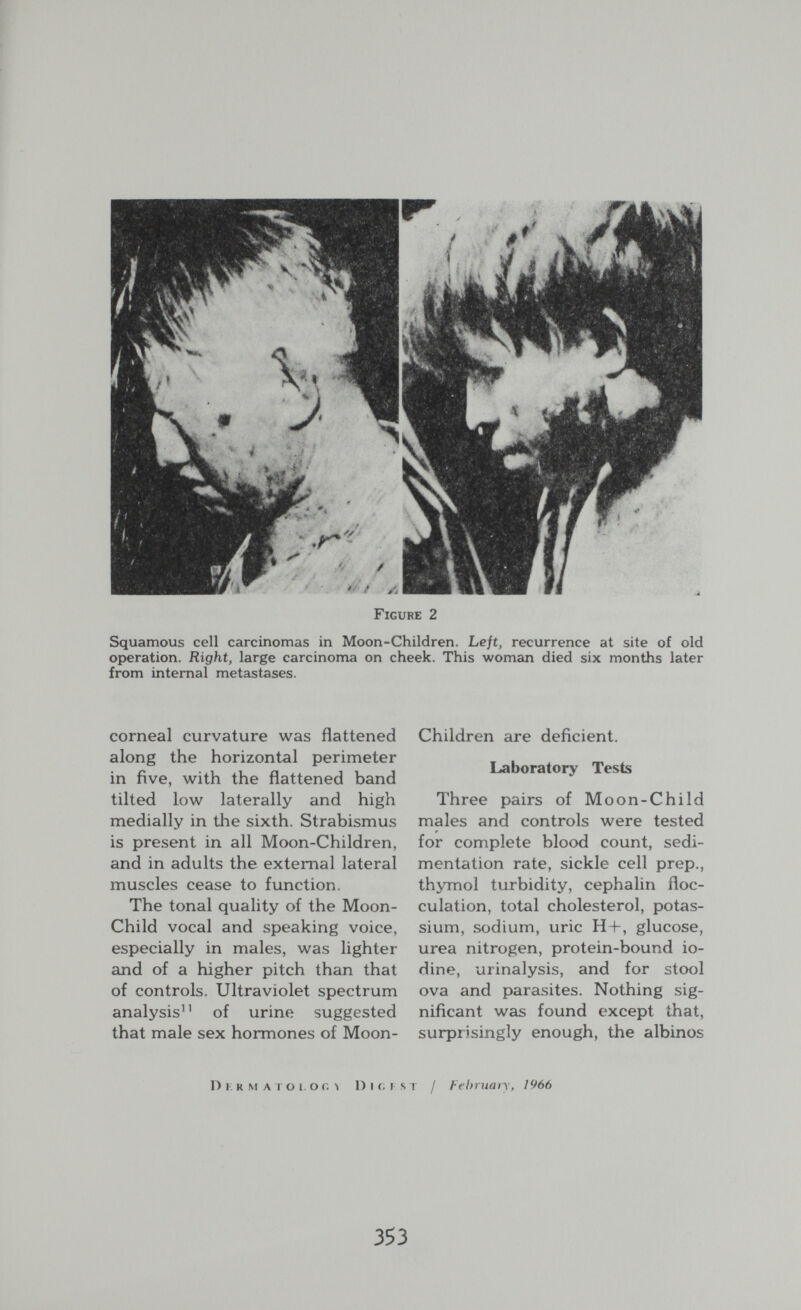Figure 2 Squamous cell carcinomas in Moon-Children. Left, recurrence at site of old operation. Right, large carcinoma on cheek. This woman died six months later from internal metastases. corneal curvature was flattened along the horizontal perimeter in five, with the flattened band tilted low laterally and high medially in the sixth. Strabismus is present in all Moon-Children, and in adults the external lateral muscles cease to function. The tonal quality of the Moon- Child vocal and speaking voice, especially in males, was lighter and of a higher pitch than that of controls. Ultraviolet spectrum analysis^' of urine suggested that male sex hormones of Moon- Children are deficient. Laboratory Tests Three pairs of Moon-Child males and controls were tested for complete blood count, sedi¬ mentation rate, sickle cell prep., thjTnol turbidity, cephalin floc- culation, total cholesterol, potas¬ sium, sodium, uric Н-Ь, glucose, urea nitrogen, protein-bound io¬ dine, urinalysis, and for stool ova and parasites. Nothing sig¬ nificant was found except that, surprisingly enough, the albinos D i; r m a г о 1. о г. > D i <; г s т / Fehriiarx, 1966 353