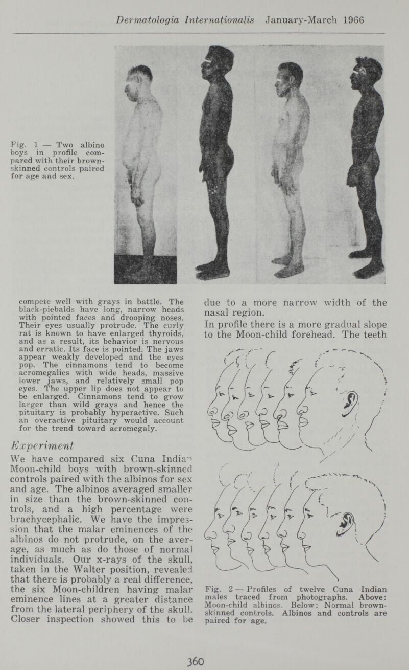 Dermatologia Internationalis January-March 1966 I: . Fig. 1 — Two albino boys in profile com¬ pared with their brown- skinned controls paired for age and sex. compete well with grays in battle. The black-piebalds have long, narrow heads with pointed faces and drooping noses. Their eyes usually protrude. The curly rat is known to have enlarged thyroids, and as a result, its behavior is nervous and erratic. Its face is pointed. The jaws appear weakly developed and the eyes pop. The cinnamons tend to become acromegalics with wide heads, massive lower jaws, and relatively small pop eyes. The upper lip does not appear to be enlarged. Cinnamons tend to grow larger than wild grays and hence the pituitary is probably hyperactive. Such an overactive pituitary would account for the trend toward acromegaly. Experiment We have compared six Cuna India! Moon-child boys with brown-skinned controls paired with the albinos for sex and age. The albinos averaged smaller in size than the brovv^n-skinned con¬ trols, and a high percentage were brachycephalic. We have the impres¬ sion that the malar eminences of the albinos do not protrude, on the aver¬ age, as much as do those of normal individuals. Our x-rays of the skull, taken in the Walter position, revealed that there is probably a real difference, the six Moon-children having malar eminence lines at a greater distance from the lateral periphery of the skull. Closer inspection showed this to be due to a more narrow width of the nasal region. In profile there is a more gradual slope to the Moon-child forehead. The teeth -y y N Fig. 2 — Profiles of twelve Cuna Indian males traced from photographs. Above: Moon-child albinos. Below: Normal brown- skinned controls. Albinos and controls are paired for age. 360