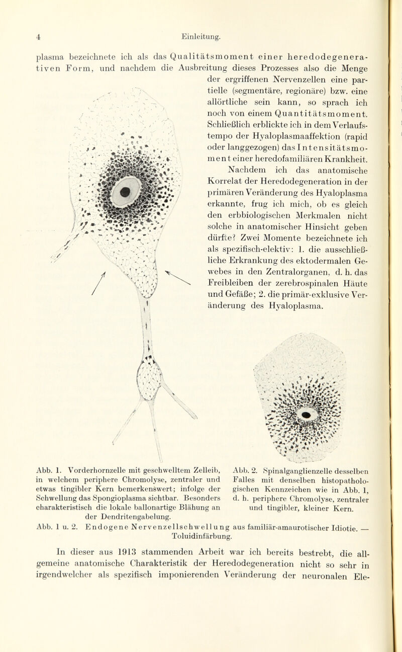 1 Einleitung. / plasma bezeichnete ich als das Qualitätsmoment einer heredodegenera- tiven Form, und nachdem die Ausbreitung dieses Prozesses also die Menge der ergriffenen Nervenzellen eine par- , ;ч tielle (segmentare, regionäre) bzw. eine 'f • , ; allörtliche sein kann, so sprach ich noch von einem Quantitätsmoment. Schließlich erblickte ich in dem Verlaufs¬ tempo der Hyaloplasmaaffektion (rapid oder langgezogen) das Intensitàtsmo¬ ment einer heredofamiliären Krankheit. Nachdem ich das anatomische Korrelat der Heredodegeneration in der primären Veränderung des Hyaloplasma erkannte, frug ich mich, ob es gleich den erbbiologischen Merkmalen nicht solche in anatomischer Hinsicht geben dürfte? Zwei Momente bezeichnete ich als spezifisch-elektiv: 1. die ausschließ¬ liche Erkrankung des ektodermalen Ge¬ webes in den Zentralorganen, d. h. das Freibleiben der zerebrospinalen Häute und Gefäße; 2. die primär-exklusive Ver¬ änderung des Hyaloplasma. ; ■ . _ Жг-Л. : - - \ ■ Л* «r >/ » . T - / . t ^ • t * * / Abb. 1. Vorderhornzelle mit geschwelltem Zelleib, Abb. 2. Spinalganglienzelle desselben in welchem periphere Chromolyse, zentraler und Falles mit denselben histopatholo- etwas tingibler Kern bemerkenswert; infolge der gischen Kennzeichen wie in Abb. 1, Schwellung das Spongioplasma sichtbar. Besonders d. h. periphere Chromolyse, zentraler charakteristisch die lokale ballonartige Blähung an und tingibler, kleiner Kern. der Dendritengabelung. Abb. 1 u. 2. Endogene Nervenzellschwellung aus familiär-amaurotischer Idiotie.— Toluidinfärbung. In dieser aus 1913 stammenden Arbeit war ich bereits bestrebt, die all¬ gemeine anatomische Charakteristik der Heredodegeneration nicht so sehr in irgendwelcher als spezifisch imponierenden Veränderung der neuronalen Ele-