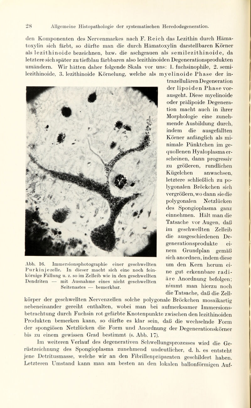 28 Allgemeine Histopathologie der systematischen Heredodegeneration. den Komponenten des Nervenmarkes nach F. Reich das Lezithin durch Häma- toxylin sich färbt, so dürfte man die durch Hämatoxylin darstellbaren Körner als lezithinoide bezeichnen, bzw. die aschgrauen als semilezithinoide, da letztere sich später zu tiefblau färbbaren also lezithinoiden Degenerationsprodukten umändern. Wir hätten daher folgende Skala vor uns: 1. fuchsinophile, 2. semi¬ lezithinoide, 3. lezithinoide Körnelung, welche als myelinoide Phase der in¬ trazellulären Degeneration der lipoiden Phase vor¬ ausgeht. Diese myelinoide oder prälipoide Degenera¬ tion macht auch in ihrer Morphologie eine zuneh¬ mende Ausbildung durch, indem die ausgefällten Körner anfänglich als mi¬ nimale Pünktchen im ge¬ quollenen Hyaloplasma er¬ scheinen, dann progressiv zu größeren, rundlichen Kügelchen anwachsen, letztere schließlich zu po¬ lygonalen Bröckchen sich vergrößern, wo dann sie die polygonalen Netzlücken des Spongioplasma ganz einnehmen. Hält man die Tatsache vor Augen, daß im geschwellten Zelleib die ausgeschiedenen De¬ generationsprodukte ei¬ nem Grundplan gemäß sich anordnen, indem diese um den Kern herum ei¬ ne gut erkennbare radi¬ äre Anordnung befolgen; nimmt man hierzu noch die Tatsache, daß die Zell¬ körper der geschwellten Nervenzellen solche polygonale Bröckchen mosaikartig nebeneinander gereiht enthalten, wobei man bei aufmerksamer Immersions¬ betrachtung durch Fuchsin rot gefärbte Knotenpunkte zwischen den lezithinoiden Produkten bemerken kann, so dürfte es klar sein, daß die wechselnde Form der spongiösen Netzlücken die Form und Anordnung der Degenerationskörner bis zu einem gewissen Grad bestimmt (s. Abb. 17). Im weiteren Verlauf des degenerativen Schwellungsprozesses wird die Ge¬ rüstzeichnung des Spongioplasma zunehmend undeutlicher, d. h. es entsteht jene Detritusmasse, welche wir an den Fibrillenpräparaten geschildert haben. Letzteren Umstand kann man am besten an den lokalen ballonförmigen Auf- Abb. 16. Immersionsphotographie einer geschwellten Purkinjezelle. In dieser macht sich eine noch fein¬ körnige Fällung u. z. so im Zelleib wie in den geschwellten Dendriten — mit Ausnahme eines nicht geschwellten Seitenastes — bemerkbar.