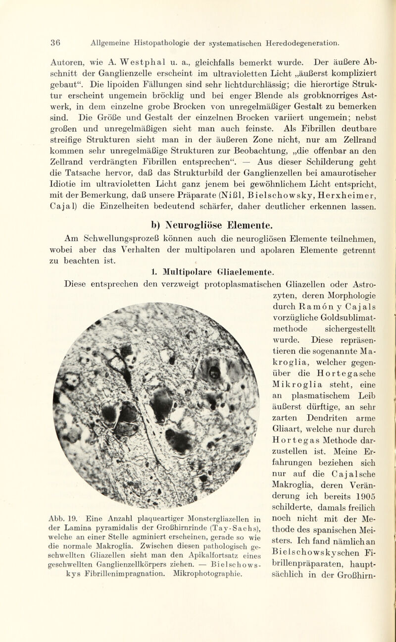 36 Allgemeine Histopathologie der systematischen Heredodegeneration. Autoren, wie A. Westphal u. a., gleichfalls bemerkt wurde. Der äußere Ab¬ schnitt der Ganglienzelle erscheint im ultravioletten Licht „äußerst kompliziert gebaut. Die lipoiden Fällungen sind sehr lichtdurchlässig; die hierortige Struk¬ tur erscheint ungemein bröcklig und bei enger Blende als grobknorriges Ast- werk, in dem einzelne grobe Brocken von unregelmäßiger Gestalt zu bemerken sind. Die Größe und Gestalt der einzelnen Brocken variiert ungemein; nebst großen und unregelmäßigen sieht man auch feinste. Als Fibrillen deutbare streifige Strukturen sieht man in der äußeren Zone nicht, nur am Zellrand kommen sehr unregelmäßige Strukturen zur Beobachtung, „die offenbar an den Zellrand verdrängten Fibrillen entsprechen. — Aus dieser Schilderung geht die Tatsache hervor, daß das Strukturbild der Ganglienzellen bei amaurotischer Idiotie im ultravioletten Licht ganz jenem bei gewöhnlichem Licht entspricht, mit der Bemerkung, daß unsere Präparate (Nißl, Bielschowsky, Herxheimer, Ca jal) die Einzelheiten bedeutend schärfer, daher deutlicher erkennen lassen. b) IVeurog'liöse Elemente. Am Schwellungsprozeß können auch die neurogliösen Elemente teilnehmen, wobei aber das Verhalten der multipolaren und apolaren Elemente getrennt zu beachten ist. 1. Multipolare Gliaelemente. Diese entsprechen den verzweigt protoplasmatischen Gliazellen oder Astro- zyten, deren Morphologie durch Ramón y Cajals vorzügliche Goldsublimat¬ methode sichergestellt wurde. Diese repräsen¬ tieren die sogenannte Ma¬ kro glia, welcher gegen¬ über die Hortegasche Mikroglia steht, eine an plasmatischem Leib äußerst dürftige, an sehr zarten Dendriten arme Gliaart, welche nur durch Hortegas Methode dar¬ zustellen ist. Meine Er¬ fahrungen beziehen sich nur auf die Caj al sehe Makroglia, deren Verän¬ derung ich bereits 1905 schilderte, damals freilich noch nicht mit der Me¬ thode des spanischen Mei¬ sters. Ich fand nämlich an Bielschowskyschen Fi- brillenpräparaten, haupt¬ sächlich in der Großhirn- Abb. 19. Eine Anzahl plaqueartiger Monstergliazellen in der Lamina pyramidalis der Großhirnrinde (Tay-Sachs), welche an einer Stelle agminiert erscheinen, gerade so wie die normale Makroglia. Zwischen diesen pathologisch ge¬ schwellten Gliazellen sieht man den Apikaifortsatz eines geschwellten Ganglienzellkörpers ziehen. — Bielschows¬ ky s Fibrillenimpragnation. Mikrophotographie.