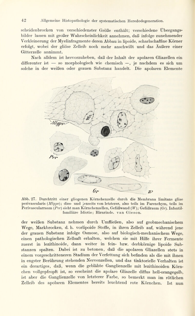 42 Allgemeine Histopathologic der systematischen Heredodegeneration. scheidenbrocken von verschiedenster Größe enthält; verschiedene Übergangs¬ bilder lassen mit großer Wahrscheinlichkeit annehmen, daß infolge zunehmender Verkleinerung der Myelinfragmente deren Abbau in lipoide, scharlachaffine Körner erfolgt, wobei der gliöse Zelleib noch mehr anschwillt und das Äußere einer Gitterzelle annimmt. Nach alldem ist hervorzuheben, daß der Inhalt der apolaren Gliazellen ein differ enter ist — so morphologisch wie chemisch —, je nachdem es sich um solche in der weißen oder grauen Substanz handelt. Die apolaren Elemente Abb. 27. Durchtritt einer gliogenen Körnchenzelle durch die Membrana limitans gliae perivascularis (3Ilgpv); dies- und jenseits von letzterer, also teils im Parenchym, teils im Perivascularraum (Pvr) sieht man Körnchenzellen, Gefäßwand {W); Gefäßraum [Qr). Infantil¬ familiäre Idiotie; Hirnrinde, van Gieson. der weißen Substanz nehmen durch Umfließen, also auf grobmechanischem Wege, Markbrocken, d. h. vorlipoide Stoffe, in ihren Zelleib auf, während jene der grauen Substanz infolge Osmose, also auf biologisch-mechanischem Wege, einen pathologischen Zellsaft erhalten, welchen sie mit Hilfe ihrer Fermente zuerst in lezithinoide, dann weiter in fein- bzw. derb körnige lipoide Sub¬ stanzen spalten. Dabei ist zu betonen, daß die apolaren Gliazellen stets in einem vorgeschritteneren Stadium der Verfettung sich befinden als die mit ihnen in engster Berührung stehenden Nervenzellen, und das tinktorielle Verhalten ist ein derartiges, daß, wenn die geblähte Ganglienzelle mit lezithinoiden Körn¬ chen vollgepfropft ist, so erscheint die apolare Gliazelle diffus hell-orangegelb, ist aber die Ganglienzelle von letzterer Farbe, so bemerkt man im rötlichen Zelleib des apolaren Elementes bereits leuchtend rote Körnchen. Ist nun