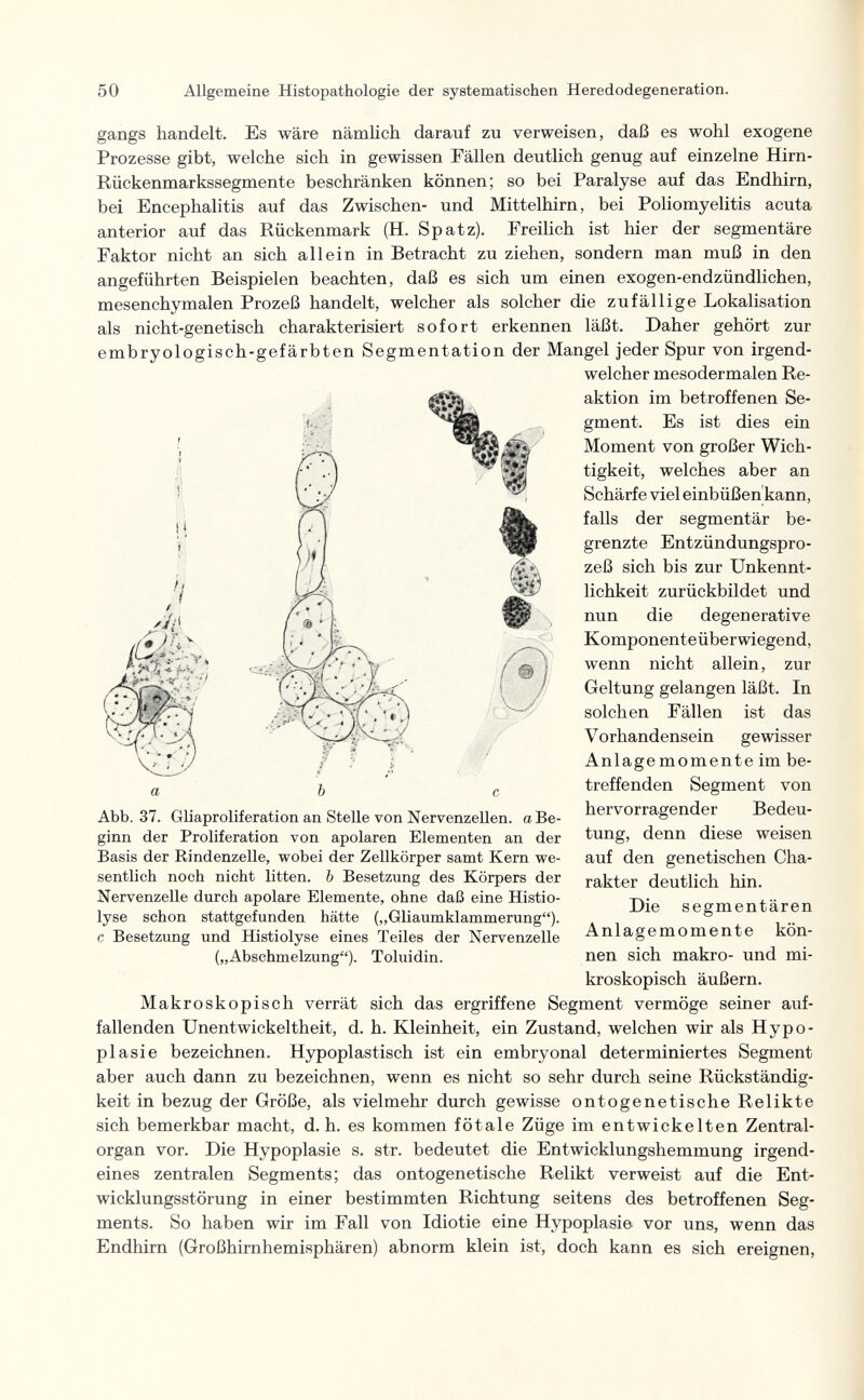 50 Allgemeine Histopathologie der systematischen Heredodegeneration. ;te: I li gangs handelt. Es wäre nämlich darauf zu verweisen, daß es wohl exogene Prozesse gibt, welche sich in gewissen Fällen deutlich genug auf einzelne Hirn- Rückenmarkssegmente beschränken können; so bei Paralyse auf das Endhirn, bei Encephalitis auf das Zwischen- und Mittelhirn, bei Poliomyelitis acuta anterior auf das Rückenmark (H. Spatz). Freilich ist hier der segmentäre Faktor nicht an sich allein in Betracht zu ziehen, sondern man muß in den angeführten Beispielen beachten, daß es sich um einen exogen-endzündlichen, mesenchymalen Prozeß handelt, welcher als solcher die zufällige Lokalisation als nicht-genetisch charakterisiert sofort erkennen läßt. Daher gehört zur embryologisch-gefärbten Segmentation der Mangel jeder Spur von irgend¬ welcher mesodermalen Re¬ aktion im betroffenen Se¬ gment. Es ist dies ein Moment von großer Wich¬ tigkeit, welches aber an Schärfe viel einbüßen kann, falls der segmentär be¬ grenzte Entzündungspro¬ zeß sich bis zur Unkennt¬ lichkeit zurückbildet und nun die degenerative Komponenteüberwiegend, wenn nicht allein, zur Geltung gelangen läßt. In solchen Fällen ist das Vorhandensein gewisser Anlagemomente im be¬ treffenden Segment von hervorragender Bedeu¬ tung, denn diese weisen auf den genetischen Cha¬ rakter deutlich hin. Die Segmentären Anlagemomente kön¬ nen sich makro- und mi¬ kroskopisch äußern. Makroskopisch verrät sich das ergriffene Segment vermöge seiner auf¬ fallenden Unentwickeltheit, d. h. Kleinheit, ein Zustand, welchen wir als Hypo¬ plasie bezeichnen. Hypoplastisch ist ein embryonal determiniertes Segment aber auch dann zu bezeichnen, wenn es nicht so sehr durch seine Rückständig¬ keit in bezug der Größe, als vielmehr durch gewisse ontogenetische Relikte sich bemerkbar macht, d. h. es kommen fötale Züge im entwickelten Zentral¬ organ vor. Die Hypoplasie s. str. bedeutet die Entwicklungshemmung irgend¬ eines zentralen Segments; das ontogenetische Relikt verweist auf die Ent¬ wicklungsstörung in einer bestimmten Richtung seitens des betroffenen Seg¬ ments. So haben wir im Fall von Idiotie eine Hypoplasie vor uns, wenn das Endhirn (Großhirnhemisphären) abnorm klein ist, doch kann es sich ereignen. I/ Abb. 37. Gliaproliferation an Stelle von Nervenzellen, a Be¬ ginn der Proliferation von apolaren Elementen an der Basis der Rindenzelle, wobei der Zellkörper samt Kern we¬ sentlich noch nicht litten. Ъ Besetzung des Körpers der Nervenzelle durch apolare Elemente, ohne daß eine Histio- lyse schon stattgefunden hätte („Gliaumklammerung). с Besetzung und Histiolyse eines Teiles der Nervenzelle („Abschmelzung). Toluidin.