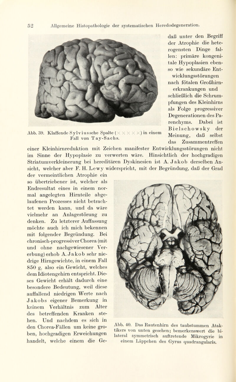 52 Allgemeine Histopathologie der systematischen Heredodegeneration. Abb. 39. Klaffende Sylviussche Spalte (X X X X Fall von Tay-Sachs. : ) in einem daß unter den Begriff der Atrophie die hete¬ rogensten Dinge fal¬ len : primäre kongeni¬ tale Hypoplasien eben¬ so wie sekundäre Ent¬ wicklungsstörungen nach fötalen Großhirn¬ erkrankungen und schließlich die Schrum¬ pfungen des Kleinhirns als Folge progressiver Degenerationen des Pa- renchyms. Dabei ist Bielschowsky der Meinung, daß selbst das Zusammentreffen einer Kleinhirnreduktion mit Zeichen manifester Entwicklungsstörungen nicht im Sinne der Hypoplasie zu verwerten wäre. Hinsichtlich der hochgradigen Striatumverkleinerung bei hereditären Dyskinesien ist A. Jakob derselben An¬ sicht, welcher aber F. H. Lewy widerspricht, mit der Begründung, daß der Grad der vermeintlichen Atrophie ein so übertriebener ist, welcher als Endresultat eines in einem nor¬ mal angelegten Hirnteile abge¬ laufenen Prozesses nicht betrach¬ tet werden kann, und da wäre vielmehr an Anlagestörung zu denken. Zu letzterer Auffassung möchte auch ich mich bekennen mit folgender Begründung. Bei chronisch-progressiver Chorea (mit und ohne nachgewiesener Ver¬ erbung) erhob A.Jakob sehr nie¬ drige Hirngewichte, in einem Fall 850 g, also ein Gewicht, welches dem Idiotengehirn entspricht. Die¬ ses Gewicht erhält dadurch eine besondere Bedeutung, weil diese auffallend niedrigen Werte nach Jakobs eigener Bemerkung in keinem Verhältnis zum Alter des betreffenden Kranken ste¬ hen. Und nachdem es sich in den Chorea-Fällen um keine gro- Rautenhirn des taubstummen Atak- -, 11 T tikers von unten gesehen; bemerkenswert die bi- ben, hochgradigen Erweichungen auftretende Mikrogyrie in handelt, welche einem die Ge- einem Läppchen des Gyrus quadrangularis.