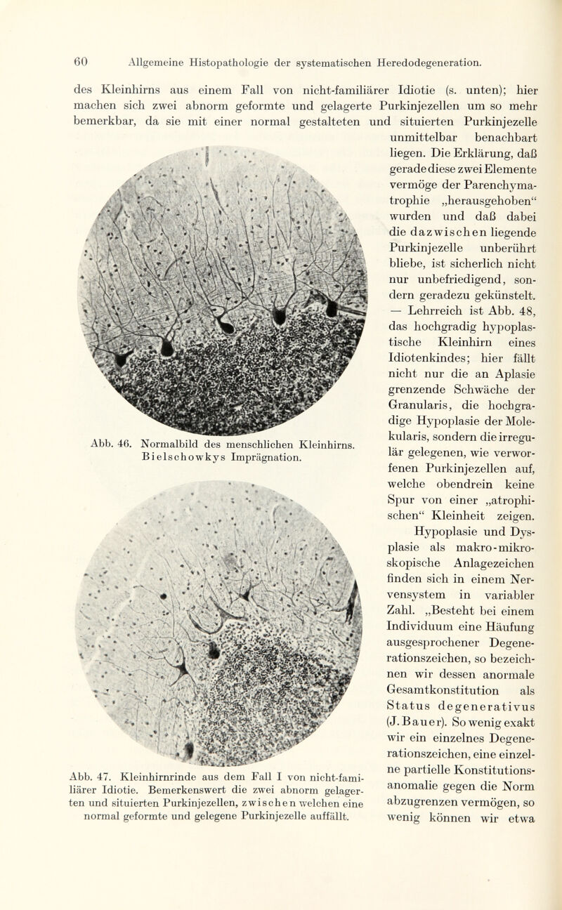 60 Allgemeine Histopathologic der systematischen Heredodegeneration. , ; - f iC'V^b^V:V.;iv. des Kleinhirns aus einem Fall von nicht-familiärer Idiotie (s. unten); hier machen sich zwei abnorm geformte und gelagerte Purkinjezellen um so mehr bemerkbar, da sie mit einer normal gestalteten und situierten Purkinjezelle unmittelbar benachbart liegen. Die Erklärung, daß gerade diese zwei Elemente vermöge der Parenchyma- trophie „herausgehoben wurden und daß dabei die dazwischen liegende Purkinjezelle unberührt bliebe, ist sicherlich nicht nur unbefriedigend, son¬ dern geradezu gekünstelt. — Lehrreich ist Abb. 48, das hochgradig hypoplas¬ tische Kleinhirn eines Idiotenkindes; hier fällt nicht nur die an Aplasie grenzende Schwäche der Granularis, die hochgra¬ dige Hypoplasie der Mole- kularis, sondern die irregu¬ lär gelegenen, wie verwor¬ fenen Purkinjezellen auf, welche obendrein keine Spur von einer „atrophi¬ schen Kleinheit zeigen. Hypoplasie und Dys¬ plasie als makro - mikro¬ skopische Anlagezeichen finden sich in einem Ner¬ vensystem in variabler Zahl. „Besteht bei einem Individuum eine Häufung ausgesprochener Degene¬ rationszeichen, so bezeich¬ nen wir dessen anormale Gesamtkonstitution als Status degenerativus (J.Bauer). So wenig exakt . wir ein einzelnes Degene- ' /W rationszeichen, eme emzel- ... , partielle Konstitutions- Abb. 47. Kleinhirnrinde aus dem i^all 1 von nicht-fami- i. liärer Idiotie. Bemerkenswert die zwei abnorm gelager- anomalie gegen die Norm ten und situierten Purkinjezellen, zwischen welchen eine abzugrenzen vermögen, so normal geformte und gelegene Purkinjezelle auffällt. wenig können wir etwa Abb. 46. Normalbild des menschlichen Kleinhirns. Bielschowkys Imprägnation. ' * Ш ' » 1' A , y*' ^'bp í'i » ■ ■ ■ -'Ч M